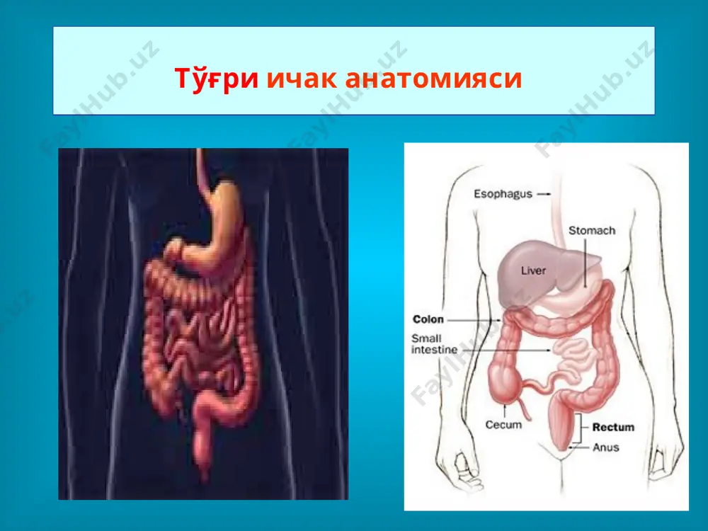 ак епик чунтаги очилади кесма линияси (а) ва ажратилган тў²ри ичак (б) орка чикарув тешиги атрезиясида ораликдан узунасига кесма оркали операция тў²ри ичак шиллик кавти очилиб шиллик кават кирраси терига тикилади. кундаланг кесимда чоклар(а) ва операциядан кецинги холат(б) орка чикарув тешиги ва тўғри ичак туғма атрезияси хирургик давоси орқа чиқарув тешиги атрезиясида тери кесилиб, унинг шиллиқ қавати пастга тортилиб терига тикиб қўйилади. тўғри ичак атрезиясининг бошқа турларида турли хил мураккаб жарроҳлик амалиётлари қўлланилади. тўғри ичак ноонкологик касалликлари геморроидал тугунлар орка чикаурв тешиги ёриги, пектеноз, папилляр гипертрофия аноректал абсцесс и орка чикарув тешиги окмаси тў²ри ичак тушиши ва сфинктер етишмовчилиги бавосил (геморрой) геморрой - тўғри ичак ғорсимон (каверноз) таначаларининг венулалар орқали, артерио-веноз анастомозларга эга бўлган тўғри ичак ғорсимон шиллиқ ости чигаллардан қонни оқиб чиқиб кетишининг бузилиши натижасида, уларнинг кенгайиши билан кечувчи касаллик ҳисобланади. касаллик жуда кенг тарқалган бўлиб, катта ёшдаги ахолининг 43,7 фоизида учрайди ва тўғри ичак касалликлари билан оғриган беморлар …