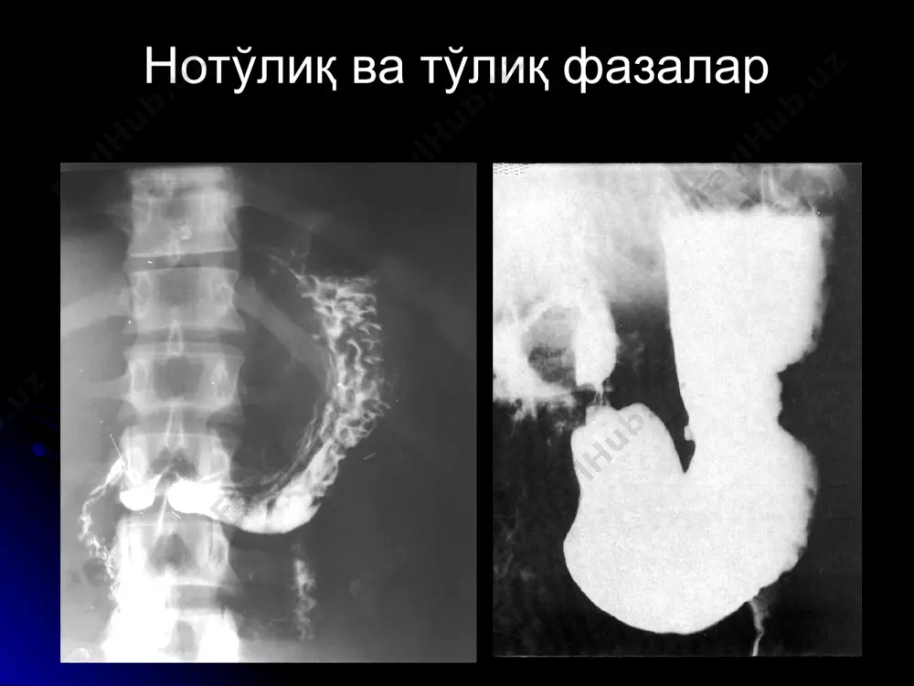 ) локал огрик яра сохасида асоратлар - 1) перфорация, 2) пенетрация 3) чандикли деформация 4)кон кетиш 5)малигнизация 12-бармокли ичак яраси ошкозон ярасига нисбатан х2-3 баравар купрок учрайди купрок эркакларда 95% пиезчада, < 1 см кичик 85% пиезча деформациялашади малигнизация йук белгилари ва асоратлари ошкозон ярасидек крон касаллиги 80% оч ва енбош ичакда уткир боскич - шиллик кават шиши, рельеф йуколиши - «булыжная мостовая» симптоми, яралар, стеноз, ригидлик сурункали боскич - чандикли торайиш («шнур» симптоми) асорати - фистула, абсцесс, стеноз, перфорация, гидронефроз, токсик мегаколон, аденокарцинома эхтимоли ошиши ичак тутилиши турлари 1) ингичка (80%) ва йугон (20%) ичакли 2) механик ва динамик асосий белги - клойбер косалари механик ичак тутилиши (ичакда тусиклик) 1) перистальтика сакланган 2) динамикада тасвир узгаради 3) стенозгача ичак кенгаяди, стеноздан сунг тораяди динамик ичак тутилиши (ичакда паралич) 1) перистальтика йук 2) динамикада узгариш йук 3) ичаклар диффуз кенгайган оддий r-графия ва ирригография ахамиятли ингичка ичак тутилиши йугон ичак …