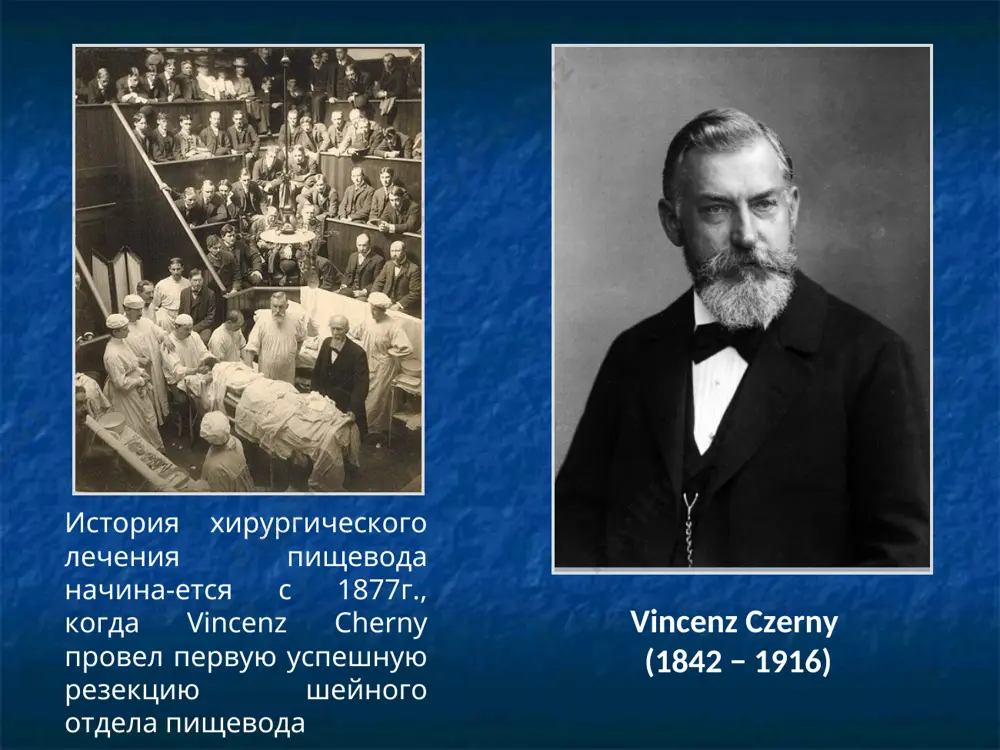 дела пищевода. iii степень – множественные , циркулярные эрозивно-язвенные поражения пищевода, занимающие всю окружность дистального отдела пищевода. iv степень – осложнения: глубокие язвы, стриктуры, пищевод баррета. лечение гэрб 0 степень – лечение консервативное 1 степень – консервативное или хирургическое 2-4 степени - хирургическое ахалазия кардии (мегаэзофагус или долихоэзофагус, идиопатическое расширение пищевода, кардиоспазм и др.) наиболее характерные симптомы ахалазии кардии дисфагия прохождение пищи после приемов, повышающих внутрипросветное давление регургитация (через несколько часов после еды ночная сразу после еды) боли (болевые кризы, не связанные с едой, боли при глотании, парестезии, зуд и т.д.) тошнота, рвота, похудание осложнения (эзофагит, переход в рак, нарушения дыхания) стадии ахалазии кардии (кардиоспазма) (б.в. петровский) i стадия - функциональный непостоянный спазм кардии, расширения пищевода не наблюдается ii стадия - стабильный спазм кардии с нерезким расширением пищевода iii стадия - рубцовые изменения мышечных слоев кардии с выраженным расширением пищевода iv стадия - резко выраженный стеноз кардии с дилатацией пищевода, …