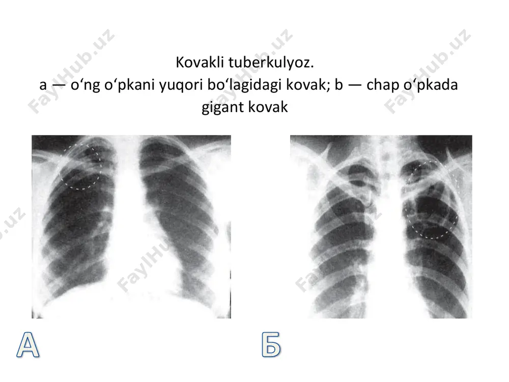 o‘ng o‘pkani kovakli tuberkulezi - Page 3