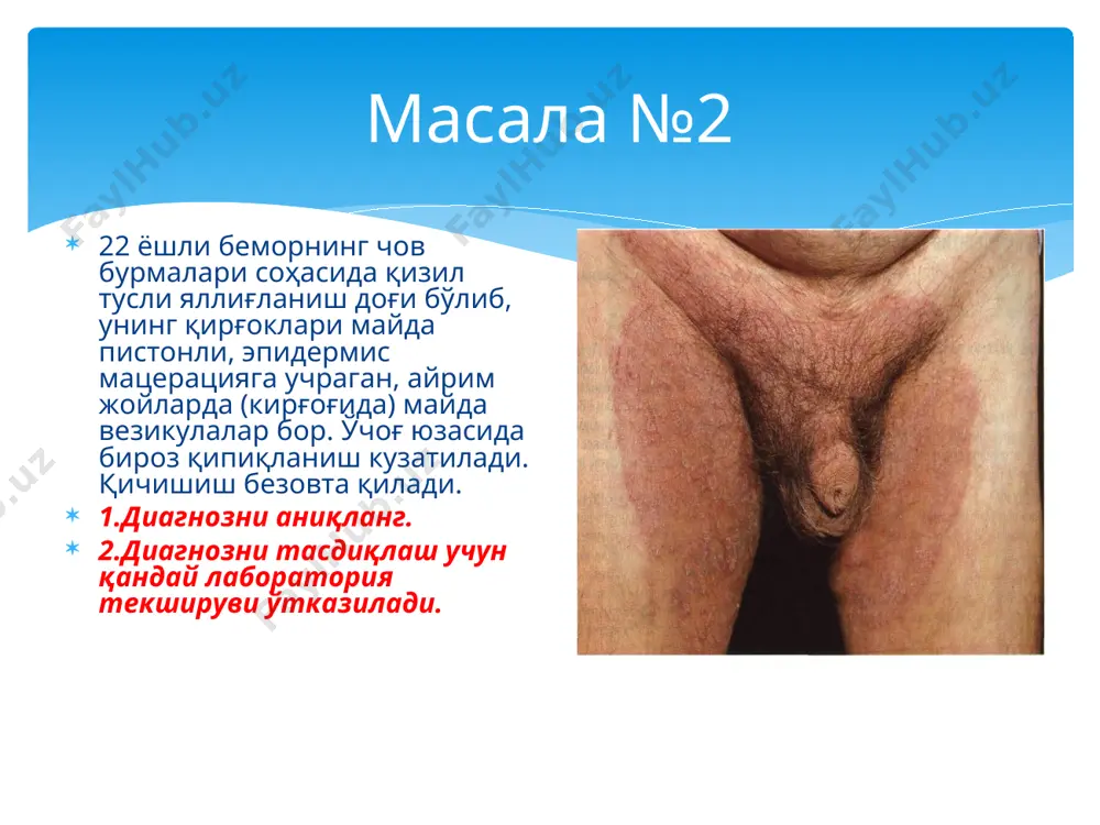 boshning sochli qismida kasallik o'chogi mavjud bo'lib, uning shakli dumaloq, o'lchami 4x5 sm, atrofida, jarohat sohasida kuchli infiltratsiya rivojlangan va yuzasida ko'pgina «follikulyar yiringchalar» bo'lib, ularning har biridan alohida-alohida yiring oqib chiqishi kuzatilmoqda, qaloqlar bor. kasallik o'chog'ida sochlar zararlangan. 1) sizning diagnozingiz? 2) diagnozni aniqlash uchun qanday tekshiruv o'tkaziladi? masala №10 kabulga kelgan 8 yoshli kizchaning chap tirsagida, bilak soxasida 1 ta kasallik uchogi bulib, ular dumalok shaklda. diametri 3x4 sm atrofida. u erda eritema dogi, mayda yuzaki pustulalar, kepaklanish, kaloklar kuzga tashlanadi. kasallik uchogi kirgogida papulalardan iborat infiltratsiya teri soxasidan biroz kutarilib bordyur xosil kilib turibdi. uchogning kirgoklari tekkis, chegarasi anik. 1) kanday kasallik? 2) diagnozni tasdiklash uchun kanday tekshirish utkazish kerak? masala №11 15 yoshli bemorning qorin sohasida kaftdek kasallik o'chog'i bo'lib, u erda teri qattiqlashib zichlashgan, ostidagi to'qimaga yopishgan, atrofida siren rangidagi hoshiya kuzatiladi. kasalik o'chog'ida ter va yog' bezlari atrofiyasi tufayli ter va yog' chiqishi kuzatilmaydi, …