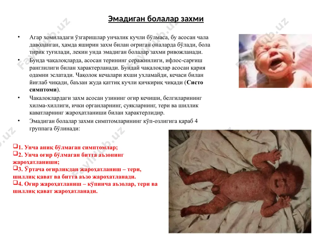prik va qoshda bo'lsa, soch, qosh, kipriklar to'kilib ketadi. agar jinsiy a'zolarda bo'lsa, yorilib yara hosil qiladi va chandiq bilan tugaydi. 7 osteoxondrit faqat tug'ma zaxm uchun xarakterli bo'lgan simptomning uchinchisi osteoxondritdir. suyaklardagi o'zgarishlar asosan homila ona qornidaligida, homila rivojlanishining 6 oyida boshlanadi. oq spiroxetalar naysimon suyaklarda tog'ay bilan suyak orasiga kirib olib, u erda osteoxondrit chaqiradi. osteoxondrit suyakni epifiz togayi bilan diaffiz qismi oralig'ida boshlanadi. shikastlanishning mohiyati shuki, patologik o'chog'da me'yordagi suyak hosil bo'lishini buzilishidan iborat bo'lib, tog'ayning fiziologik rivojlanishi izdan chiqadi, tog'ay hujayralarida ohak to'plana boradi. shu bilan bir vaqtda suyaklanish zonasida spetsifik infiltrat vujudga keladi, u emirilib, neqrotik joylar hosil qilishiga moyil bo'ladi. 8 tug'ma zaxm zaxm osteoxondritining uchta darajasi ajratiladi. i-darajali osteoxondritda tog'oy bilan suyak o'rtasida tog'oy hujayralarining ohaklanish yo'li kengayib qoladi, bu joyda ohak tuzlari me'yordagidan ko'ra ortiqcha miqdorda to'planadi. tog'ay bilan suyak orasidagi tasma (polosa) 2 mm gacha kengayib boradi (me'yorda – 0,5 mm). …
