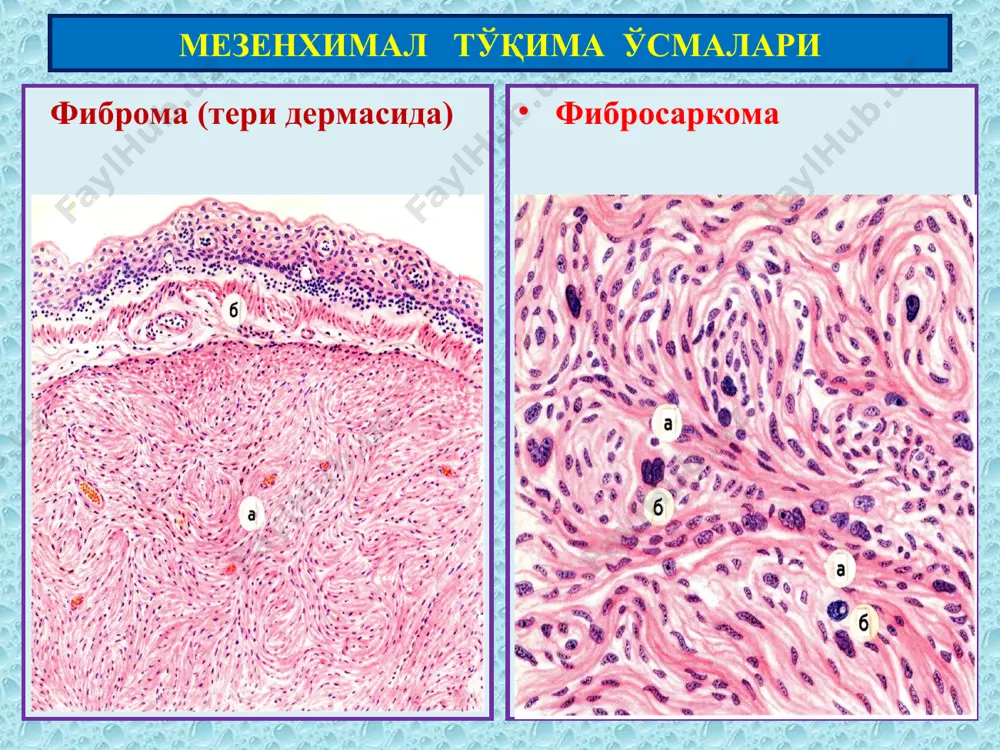 менингиал ва мия пардалари ўсмалар менингиома псамома невринома нейролеммома, шваннома. кўп учрайдиган ўсма. таёқсимон ядроли шванн ҳужайраларидан ўсади. бетартиб ретикуляр тўр пайдо қилиб жойлашиши мумкин ретикуляр невринома ритмик тузилишга эга бўлиши мумкин – фассикуляр невринома периферик нерв тизими ўсмалар ретикуляр невринома фассикуляр невринома