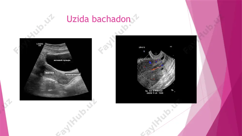 ayollar reproduktiv tizimi a’zolariining nurtashhislash usullari - Page 5