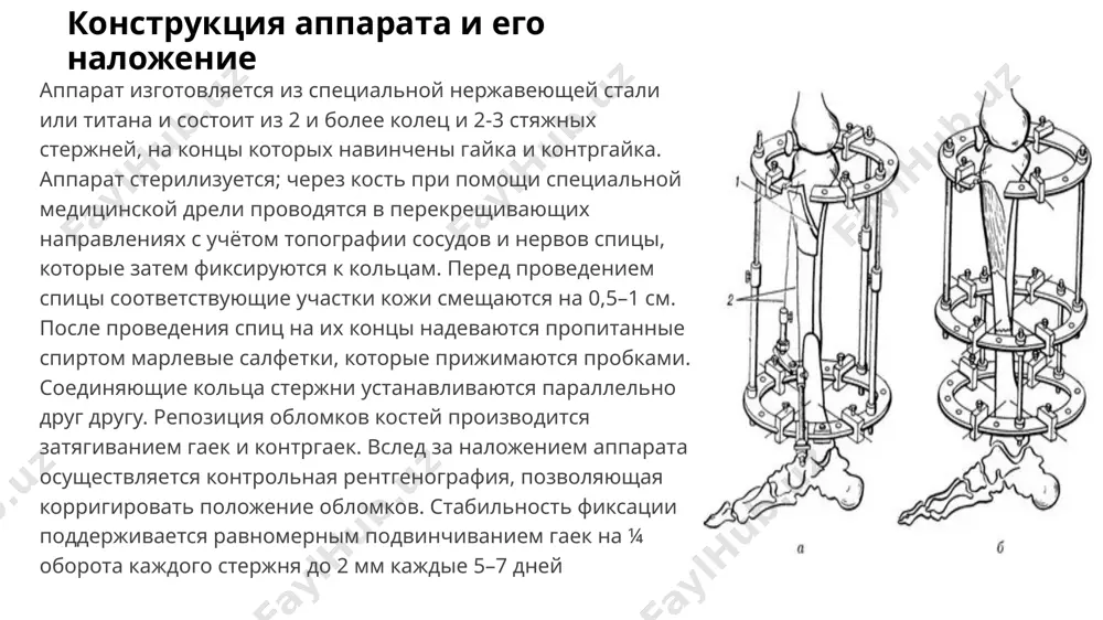 аппарат илизарова - Page 5