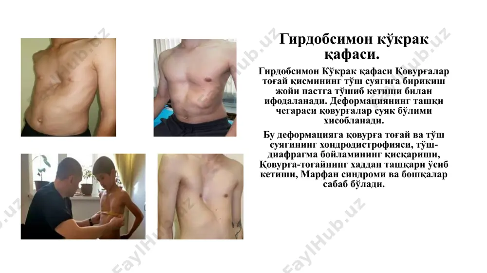 lik muolajasi 3 yoshdan oshgan bemorlarda o'tkaziladi. muolaja deformatsiyaga uchragan qovurg'aning tog'ay qismini segmentar olib tashlash, to'sh osteotomiyasi va to'sh-diafragma boy-lamini kesishdan iborat. bu muxim omil bo'lib, to'sh va qovurg'a-larni bir xil xolatda ushlab turish bilan tugallanadi, boshqa xildagi torakoplastik shu usul bilangina bir-biridan farq qiladi. bunda to'sh osti soxasiga metall plastinka qo'yiladi va tashqaridan magnit o'rnatilgan korset kiydiriladi. tor­tib turish muddati 1—1,5 oy. to'sh osti soxasidan plastinka yarim yildan keyin olib tashlanadi. ko'krak kafasnning qayiqsimon deformatsiyasi. bu ko'pgina xollarda qovurg'a va to'sh suyaklarining tug'ma rivojlanish nuqsoni xisoblanadi. ba'zi mualliflarning fikricha, diafragmaning to'sh qismi nuqsonli rivojlanishi xisobiga yupqalashgan, muskul tolalari kam, bu paytda qovurg'a qismi biroz gipertrofiyalangan bo'lib, qovurg'alarni ichkariga tortadi, shu bilan to'shni oldinga itaradi. ba'zan kasallikning nasliy kelib chiqishi kuzatiladi. ko'krak qafasining deformatsiyasi odatda bola tug'ilgandan keyin sezilarli bo'ladi. oldinga chiquvchi to'sh va qovurg'ani uni chekkasidan botib turishi (ko'pincha viii gacha) ko'krak qafasiga xarakterli qayiqsimon shaklni beradi. to'shning …