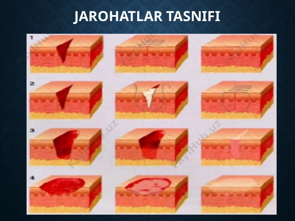o'zgarishlar. jarohatning chuqurligiga qarab, yuza, teshib o'tgan jarohat va a'zolarning shikastlanishi farq qilinadi. masalan, teri, teri osti va qorin mushaklari shikastlanishi yuza jarohatlarga kiradi, agar qorin pardasi shikastlansa, teshib o'tgan jarohat hisoblanadi. shikastlanishda ichki organlar, masalan, jigar, taloq yoki boshqa organlar jarohatlansa, unda jarohat asoratli hisoblanadi. shikastlangan to'qima va organlarga qarab, yuz kalla, bo'yin, qo'l-oyoq jarohatlari farqlanadi, ya'ni ular aseptik va infeksiya tushgan jarohatlarga bo'linadi. aseptik jarohatlarga operatsiya yoki birlarnchi yordam berilgan jarohatlar, shartli ravishda kesilgan yoki chopilgan jarohatlar kiradi. qolgan jarohatlar teri va atrofdagi narsalar orqali infeksiya tushganligi uchun ifloslangan, ya'ni infeksiya tushgan jarohatlar hisoblanadi. shuningdek, jarohatlar yangi yoki kechikkan bo'ladi. yangi jarohat deb, shikastlanish ro'y bergandan keyin 24 soat ichida bcmorga yordam ko'rsatilishiga aytiladi. bu davr ichida jarohat chekkalari kesib olinib, jarohat infeksiyasining oldini olish mumkin va ifloslangan jarohatni aseptikka aylantirishiga imkon tug'iladi. agar bemor 24 soatdan so'ng murojaat qilgan bo'lsa, u jarohat kechikkan jarohat hisoblanadi. jarohat bitishiga …