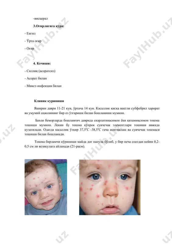 a toshishi mumkin. lekin bu toshma ko'prok suvchechak elementlari toshishi avjida kuzatiladi. odatda kasallik o'tkir 37,50s -38,50s gacha isitmalash va suvchechak toshmasi toshishi bilan boshlanadi. toshma birlamchi ko'rinishi mayda dog' papula bo'lib, u bir necha soatdan keyin 0,2-0,5 sm li vezikulaga aylanadi (21-rasm). 21-rasm.suvchechak toshmalari. vezikula yumaloq yoki oval shaklda, yuzaki joylashgan, asosida infiltrat bo'ladi. xoshiyasimon qizarish bilan o'ralgan, usti tarang, suyuqligi tiniq. pufakchalar odatda bir kamerali bo'lib, teshib qo'yilsa puchayib qoladi. toshmalar birinchi sutka oxiriga kelib quriydi, bo'shashadi va jigarrang qatqaloqga aylanadi. qatqaloq kasallikning 1-3 xaftasiga kelib tushib ketadi. ular o'rniga 2-3 oygacha pigmentli dog'lar qoladi, chandiq xosil bo'lmaydi. toshmalar bemor yuzida, bosh sochli qismida, badan va oyoq qo'llarda toshib, oyok-qo'l kaftlarida bo'lmaydi. ba'zida toshmalar og'iz shilliq qavati (22-rasm), konyuktiva (23-rasm) kamrok xollarda hikildoq, jinsiy a'zolar shilliq qavatida toshadi. 22-rasm. tanglayda suvchechak toshmalari. 23-rasm. konyuktivada suvchechak toshmalari. bu toshmalar mayin bo'lib tezda yuzaki eroziyalarga aylanadi. bunda bir oz og'riq …