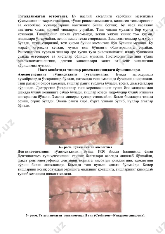 жланмаган илдиз чўққисига суякда остеопароз ва кисталар бўлиши мумкин. гистологик дентини тўлиқ ривожланмаганлигини, дентин каналчалари калта ва кенг эканлигини кўришимиз мумкин. насл оқибатида тишлар ривожланишидаги бузилишлари. амелогенезнинг тўлиқсизлиги тугаланмаган. бунда эктодермада хужайраларда ўзгаришлар бўлади, натижада тиш эмальида бузилиш аниқланади. тиш размери бироз камаяди, тишлар ранги турлича бўлади, трема, диастемалари кўринади. деструктив ўзгаришлар тиш коронкасининг тунка ёки қалқонсимон шаклда бўлиб қолишига сабаб бўлади, тишлар юзаси ғадр-будир бўлиб кўпинча жигарангда бўлади. эмалда минерал тузлар етишмайди. баъзи болаларда тишда сезиш, оғриқ бўлади. эмаль ранги хира, бўрга ўхшаш бўлиб, йўллар эгатлар бўлади. 6 – расм. тугаланмаган амелогенез дентиногенезнинг тўлиқсизлиги. бунда 1920 йилда балишмид ёзган дентиногенез тўлиқсизлигини клиник белгилари асосида аниқлаб бўлмайди, фақат рентгенографияда дентинни нормага нисбатан юпқалигини, камлигини кўриш билан аниқланади. баъзида тиш пульпа қавати бўлмайди. бемор тишларини иссиқ совуқдан оғришига милкнинг қонашига, тишларнинг қимирлаб тушиб кетишига шикоят қилади. 7– расм. тугалланмаган дентиногенез ii тип (стейнтон—капдепон синдроми). пародонта гингвит, пародонтит бўлади. тиш илдизи қисқарган …