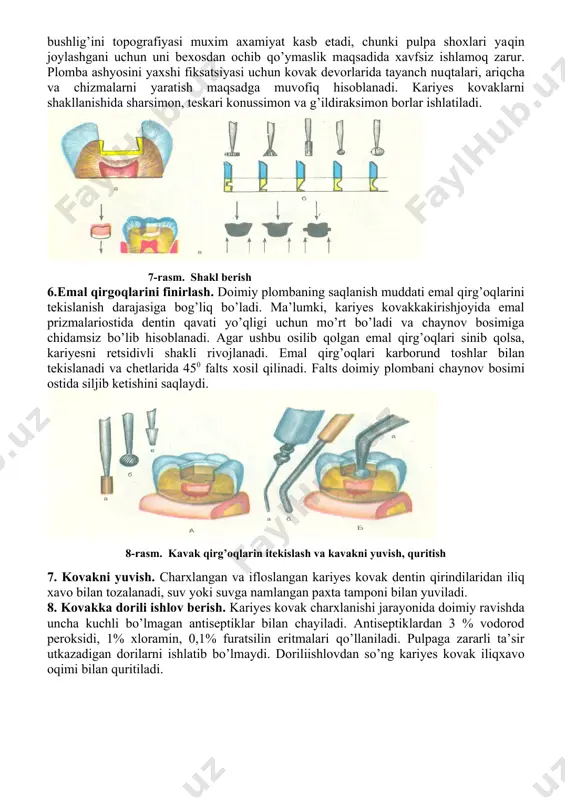 oektomiya 5.kariyes kovaknishakllantirish. bu bosqichni maqsadi – doimiy plombani fiksatsiyasi uchun optimal sharoit yaratilishi hisoblanadi. kovakka shakl berishda tishning topografiyasi inobatga olinishi kerak. yuza va o’rta kariyesni shakllantirishda kovak devorlaritubiganisbatan to’g’riburchakli, tekis, tubiesayassivasilliq bo’lishi lozim. kovaknishakliuchburchak, to’rtburchak, krestsimon, qaldirg’och dubi kabi bo’lishi mumkinvafissuralarni anatomik shakligamos bo’lishi lozim. chuqur kariyesda tish bushlig’ini topografiyasi muxim axamiyat kasb etadi, chunki pulpa shoxlari yaqin joylashgani uchun uni bexosdan ochib qo’ymaslik maqsadida xavfsiz ishlamoq zarur. plomba ashyosini yaxshi fiksatsiyasi uchun kovak devorlarida tayanch nuqtalari, ariqcha va chizmalarni yaratish maqsadga muvofiq hisoblanadi. kariyes kovaklarni shakllanishida sharsimon, teskari konussimon va g’ildiraksimon borlar ishlatiladi. 7-rasm. shakl berish 6.emal qirgoqlarini finirlash. doimiy plombaning saqlanish muddati emal qirg’oqlarini tekislanish darajasiga bog’liq bo’ladi. ma’lumki, kariyes kovakkakirishjoyida emal prizmalariostida dentin qavati yo’qligi uchun mo’rt bo’ladi va chaynov bosimiga chidamsiz bo’lib hisoblanadi. agar ushbu osilib qolgan emal qirg’oqlari sinib qolsa, kariyesni retsidivli shakli rivojlanadi. emal qirg’oqlari karborund toshlar bilan tekislanadi va chetlarida 450 …
