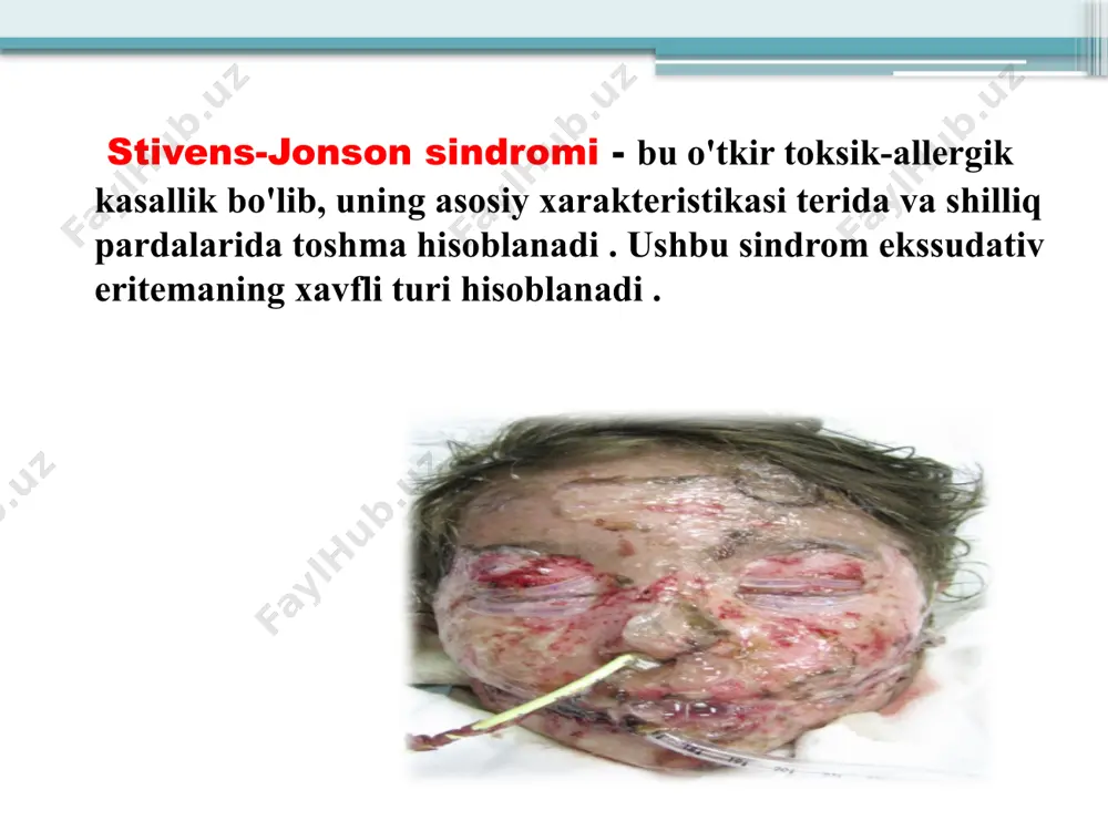i ishlab chiqaradi. granulizin keratinotsitlarning apoptoziga, keng epidermal nekrozga va pufakchaga olib keladi. genetik moyillik turli dorilarga yuqori sezuvchanlik : hla-b*1502 karbamazepin, asetazolamid, etosuskiyamid, lamotrigin, fenobarbital, fenitoin, natriy valproat bilan chambarchas bog'liq.; hla-b*5801 - allopurinol tomonidan chaqirilgan stivens-jonson sindromi bilan. preparatning (antigen) o'ziga xos hla alleli bilan keratinotsitlarga bog'lanishi cd8 + sitotoksik t limfotsitlarining o'ziga xos t hujayralari retseptorlari preparatni + hla kompleksini taniydi. klinik ko’rinishi dastlab, kuchli isitma va mushaklar va bo'g'imlarda og'riq kuzatiladi. keyin hujayralarning nobud bo’lishi, og'iz, tomoq, ko'z, boshqa terining va shilliq pardalarning shilliq qavatida juda katta pufakchalarning paydo bo'lishiga olib keladi, teri nuqsonlari kulrang-oq plyonkalar bilan qoplanadi, yoriqlar rivojlanadi. og'izning shilliq qavatining shikastlanishi ovqat eyishni qiyinlashtiradi, og'zini yopish kuchli og'riqni keltirib chiqaradi. ko'z shilliq qavatining yallig'lanishi ham rivojlanib - kon'yunktivit (allergik). shox parda fibrozga aylanadi . siydik chiqarish qiyin va og'riqli bo'ladi. differensial diagnostika stivens-jonson sindromini pemfigus vulgaris, tana yuzasining 30% dan ko'prog'i epidermal ajralishi …