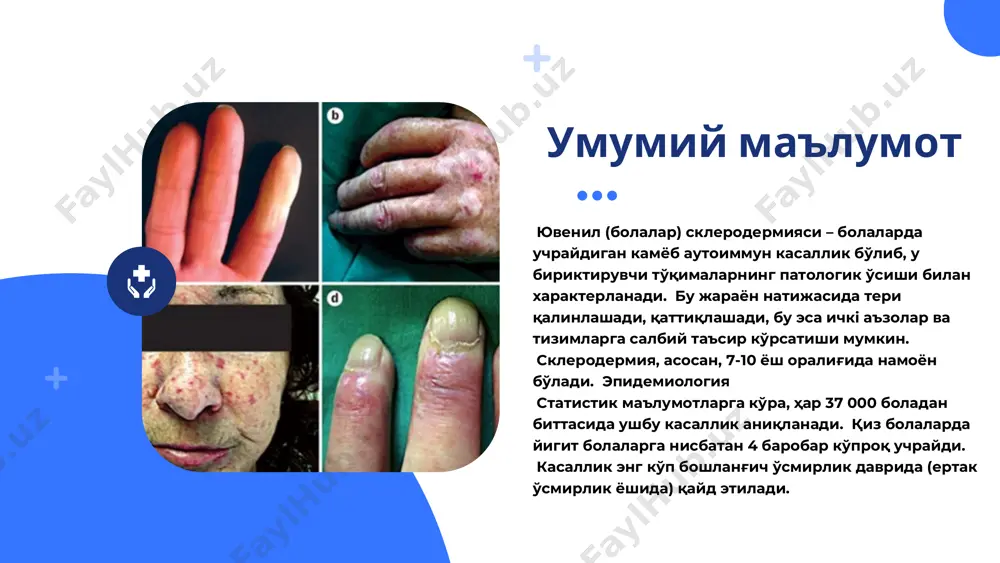 иятига таъсир қилиб, ҳаракат чегараланиши ва бўғим касалликлари пайдо бўлишига сабаб бўлади. системали склеродермия тана бўйлаб терининг кучли қалинлашуви билан намоён бўлади. системали склеродермия (сс) ёки системали склероз болаларда энг кўп учрайдиган шакл. бляшкалар бир чизиқ сингари жойлашади. тананинг ҳар қандай қисмида, шу жумладан, сочли қисмда ҳам пайдо бўлиши мумкин. мушак ва суяк тузилмалари зарарланиши сабабли ҳаракат чекланиши мумкин. энг кам учрайдиган тури. терига эмас, балки тери ости тўқималарига, мушакларга, бўғимларга, пайларга ва ички аъзоларга таъсир қилади. энг хавфли шакл ҳисобланади. локаллашган склеродермиянинг турлари тананинг икки ва ундан ортиқ соҳалари зарарланади. кўпинча оёқлар ва танада кузатилади. бляшкалар бир-бири билан қўшилиб, катта доғларни ҳосил қилиши мумкин. генерализланган морфея чегараланган (ўчоқли) склеродермия боланинг терида кичик бляшкалар пайдо бўлади. кўпинча бир жойда, кам ҳолларда иккита жойда кузатилади. айрим ҳолларда, тери остида жойлашган бириктирувчи тўқималар ҳам зарарланиши мумкин. склеродермиянинг энг енгил ва кам хавфли тури. буллез морфея бляшкалар устида "булл" – ҳаво билан тўлган …