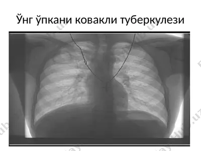 ўнг ўпкани ковакли туберкулези — PPTX