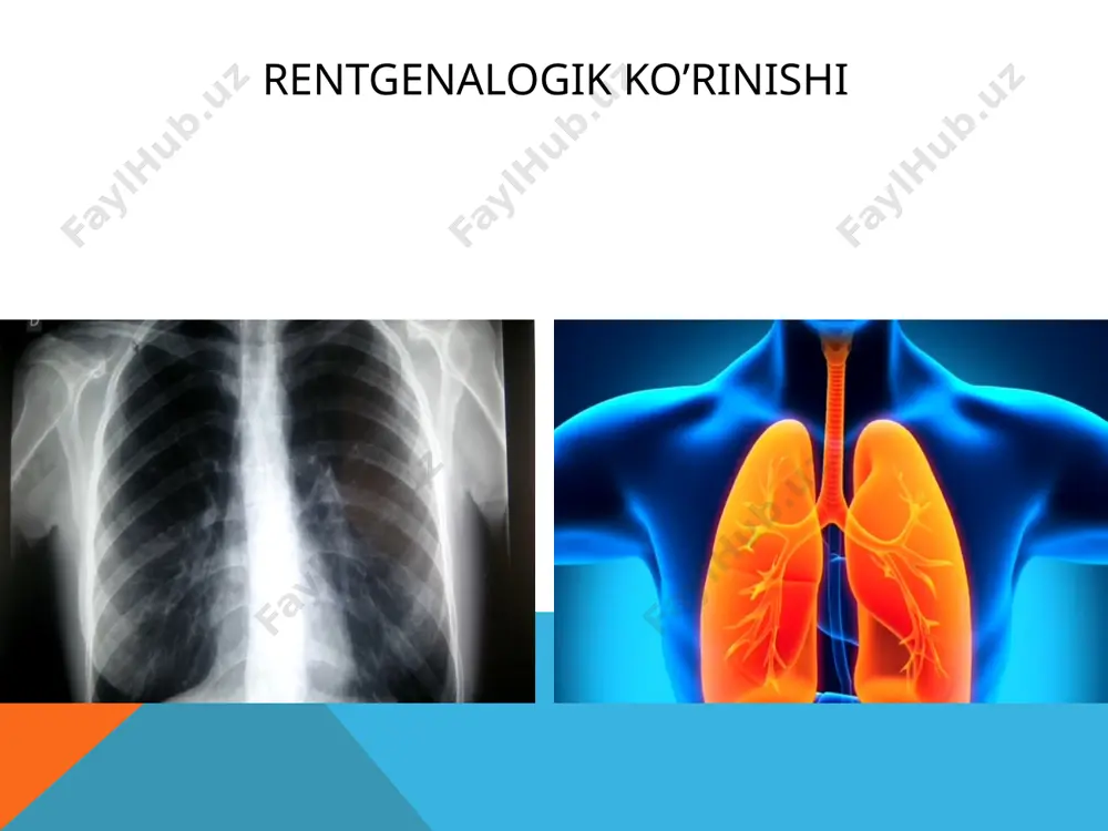 yo`llari to`qimalarda virusning reproduksiyasi virusimeya,toksinemiya va tosik-allergic reaksiyalar lokalizatsiyasiga ko`ra nafas yo`llarining zararlanishi bakterial asoratlarning bo`lishi patalogik jarayonning orqaga qaytishi grippning klassifikatsiyalanishi etiologiyasi bo`yicha: a,b,c og`irlik formalari bo`yicha: yengil o`rta og`ir og`ir gipertoksik harakteri bo`yicha: bir tekisda asoratlarsiz virus asotsatsiyasi bilan kechuvchi asoratlar bakterial asoratlar o`rvi ko`p tarqalgan kasallik bo`lib,eng ko`p tarqalgan infeksion kasallik hisoblanadi va shuning uchun uning tarqalishi haqida aniq sonlar aytish qiyin bolalar hayotining birinchi oylarida deyarli kasallanmaydilar. eng ko`p uchrash foizi 1-2 yoshdagi bolalar hisoblanadi o`rvi ni manbai bo`lib kasal kishi yoki ba`zi hollarda hayvonlar yoki qushlar hisoblanadi deyarli ko`pchilik holatda yuqish yo`li havo-tomchi yo`li orqali bo`ladi bazan infeksiya maishiy-kontakt orqali ham yuqishi mumkin patogenezi kasallikni boshlang`ich bosqichida “kirish darvozalarida”ko`payadi burunda, burun-halqumda,tomoqda. klinik tumov,tomoqda qirilish,quruq yo`tal kabi belgilar bilan namoyon bo`ladi. temperatura odatda ko`tarilmaydi bazan bu jarayonga ko`z shilliq qavati va oshqozon-ichak trakti qo`shiladi o`rvi ni asosiy simptomlari-tumov,yo`tal,aksirish,bosh og`rig`i,tomoqda va ko`z soqqasida og`riq,ko`ngil aynish,suyuq ich kelishi,umumiy …