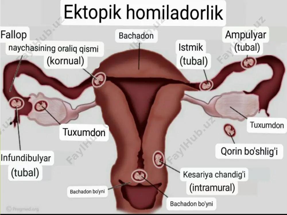 niladi. ko'pgina hollarda laparoskopik operatsiya o'tkaziladi, bu faqat bachadon trubkasi yorilib ketganda qo`laniladi. kimyoterapiya. metotreksat bilan davolash erta homiladorlikda samarali bo'ladi; xomilani rivojlanishi va rezorbsiyasini to'xtatishga olib keladi. oqibatlari . ektopik homiladorlik keyinchalik bepushtlik va takroriy ektopik homiladorlikka olib kelishi mumkin. oddiy homiladorlikda tug'ish ehtimoli taxminan 50%, takroriy ektopik homiladorlik - taxminan 20%, bepushtlik - taxminan 30%. metotreksat bilan davolash jarrohlik bilan solishtirganda yoki uni olib tashlash bilan solishtirganda fallop naychasini saqlab qolish bilan, bepushtlik va takroriy ektopik homiladorlik ehtimoli kamroq bo'ladi. foydalanilgan adabiyotlar ro‘yxati патологическая анатомия: учебник / а.и.струков, в.в.серов. – м.: литтера, 2014. – 880с.:ил. (учеб. лит. для студ. мед. вузов). патологическая анатомия: учебник / а.и.струков, в.в.серов. – м.: литтера, 2010. – 848с.:ил. (учеб. лит. для студ. мед. вузов). e'tiboringiz uchun rahmat! image1.jpeg image2.jpeg image3.jpeg image4.jpeg image5.png image6.jpeg image7.png image8.jpeg image9.png image10.png image11.png image12.jpeg image13.jpeg image14.jpeg image15.jpeg image16.jpeg image17.jpeg image18.jpeg image19.jpeg