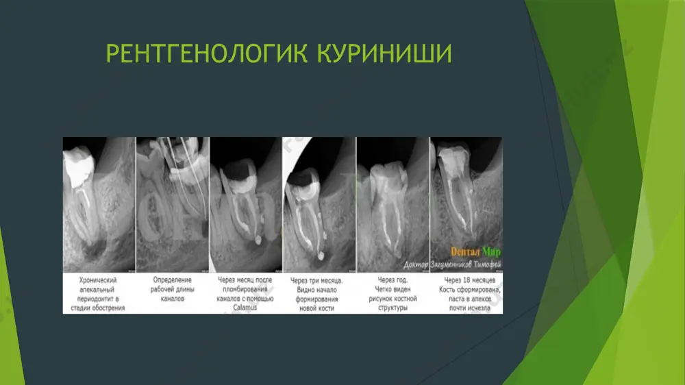 peridontitlar va rentgenologik kuring - Page 3