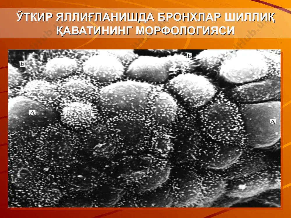 ини бошланиши шу билан тушунтирилади. ўпка , афх ўнг ўпка 3 бўлакдан иборат—юқори, ўрта ва пастки, чап ўпка эса — 2 бўлакдан — юқори ва пастки. ўнг ўпканинг ўрта бўлагига чап ўпкада тилчали бўлак тўғри келади. ўпканинг алоҳида бўлакларининг ривожланиши бир текис кечмайди. болаларда ҳаётнинг 1 —йилида чап ўпканинг юқори бўлаги суст ривожланган, ўнг ўпканинг юқори ва ўрта бўлаклари эса деярли бир ҳил ўлчамга эга. фақатгина 2 ёшга бориб ўпканинг алоҳида бўлаклари, катталарники сингари, бир —бирига мос келади. ўпка ўнг ўпкада 10 та сегмент фарқ қилинади, чап ўпкада эса 9 та. юқориги ўнг ва чап бўлаклар 3 та сегментга бўлинади: юқори чўққили-1, юқори opқa-2, юқори олдинги-3. айрим ҳолларда мустақил деб хисобланмайдиган яна бир қўшимча сегмент қўлтиқ ости сегменти фарқланади. ўнг ўрта бўлак 2 та сегментга бўлинади: ўрта —ёнбош сегмент —4 (у орқада жойлашади) ва олдинда жойлашган ўрта — олдинги сегмент — 5. ўпка чап ўпканинг ўрта бўлагига тўғри келувчи тилчали …