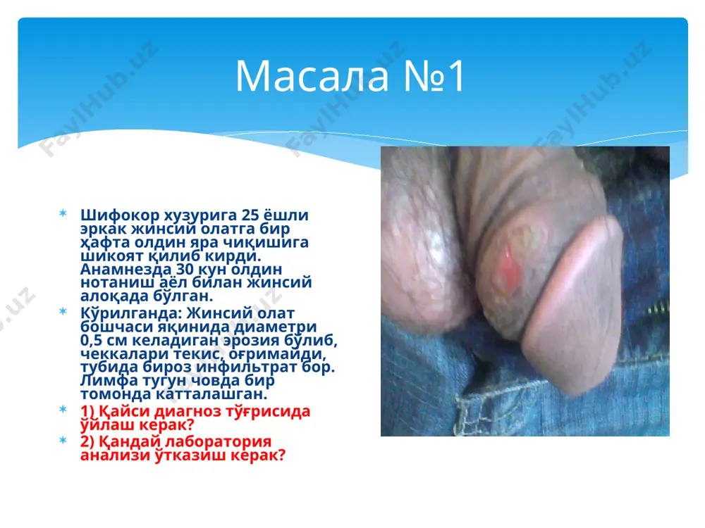 yuring. masala№5 tuman vrachlik punktiga 28 yoshli erkak, shofer, uretradan yiring chiqishiga, siyganda achishishga shikoyat qilib murojaat qildi. anamnezi: 6 kun oldin begona ayol bilan jinsiy aloqada bo'lgan. ko'rilganda: uretra labchalari qizargan, shishgan, yiringli qaloqlar bilan qoplangan. uretradan oqish-sarg'ish rangdagi yiring ajralyapti. palpatsiyada uretra biroz infiltratlashgan, og'riydi. limfa tugunlari kattalashmagan. 1) sizning diagnozingiz? 2) diagnozni tasdiqlash uchun qanday analiz o'tkazish kerak? masala №6 akusher-ginekologga 32 yoshli ayol, jinsiy a'zosidagi biroz qichishishga shikoyat qilib murojaat qildi. ishlamaydi, eridan ajrashgan, betartib jinsiy hayot kechiradi. ko'rilganda: genitaliyda va orqa peshov atrofida joylashgan pushti-qizil rangdagi vegetatsiyalangan papulalar bo'lib, keng asosda joylashgan. papulalar tubida infiltratsiya bo'lib, u ushlab ko'rilganda og'rimaydi. ginekolog «o'tkir uchli kondiloma» diagnozini qo'ydi. 1) sizning diagnozingiz? 2) diagnozni tasdiqlash uchun qanday analizlar o'tkazish kerak? masala №7 bemor ayol, 30 yoshda dermatolog huzuriga yuz sohasidagi toshmaga shikoyat qilib murojaat qildi. ko'rilganda: bemoning o'ng yonoq sohasidagi terida joylashgan bir guruh do'mboqchalar bo'lib, bu do'mboqchalar …