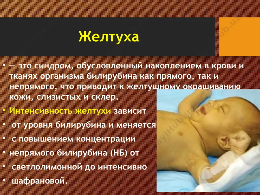 на может быть слегка повышена. антенатальная диагностика гбн анамнез матери (предшествующие аборты, мертворожденные, выкидыши, рождения больных детей, гемотрансфузии без учета резус-фактора) определение титр противорезусных антител в крови у резусотрицательных женщин исследование околоплодных вод, полученные методом амниоцентеза узи исследования постнатальная диагностика гбн клинические симптомы (желтуха, анемия, гепатоспленомегалия) повышение в крови непрямой фракции билирубина эритробластоз, ретикулоцитоз, положительная проба кумбса при резус-конфликте. консервативное лечение фототерапия – при фототерапия происходит фотоокисление непрямого билирубина, находящегося в коже с образованием водорастворимых изомеров, выводящихся с мочой и калом экспресс-опрос составьте swot- анализ по фототерапии у новорожденных s-сильные стороны w-слабые стороны o-возможности t-препятствия и угрозы консервативное лечение индукторы микросомальных ферментов печени –фенобарбитал витамин е,в1,в2,в6,с и кокарбоксилаза улучшает работу печени и стабилизирует обменные процессы с целью торможения абсорбции билирубина в кишечнике назначают очистительные клизмы, активированный уголь синдром сгущения желчи купируют назначением желчегонных средств (магния сульфат, дротаверина, но-шпы) оперативные методы лечения:зпк, гемосорбция, плазмаферез абсолютные показания к зпк: -концентрация непрямого билирубина …