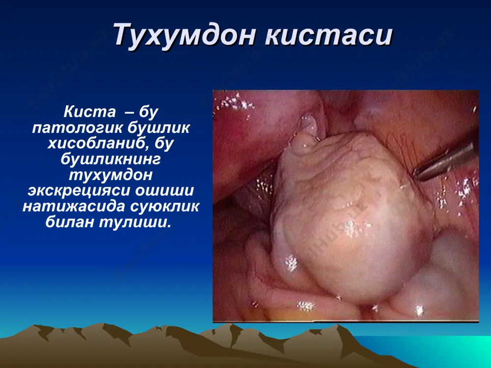 lik usulida – tuxumdon soglom tukimalarni koldirgan xolda kistani olib tashlash, kista usgan joyidan yoki buralgan kismidan.tuxumdonni ponasimon kesish. tuxumdon usmalari tuxumdon kistomalarining katta kismini yaxshi sifatli epitelial usmalar tashkil kiladi. kistoma – chin tuxumdon usmasi bulib, tez usish bilan xarakterlanadi. tarkalishi – jinsiy a'zolar usmalarini 19-25%ni tashkil kiladi 75–80% ni yaxshi sifatli usmalar tashkil kiladi. klassifikatsiya epitelial usmalar gormon- aktiv usmalar germinogen usmalar epitelial usmalar seroz usmalar mutsi- noz usmalar endomet- rioidli usmalar brenner usmalari tuxumdon usmalari oddiy seroz tsist- adenoma papil- lyar seroz tsist- adenoma papil- lyar tsist- adenoma psevdo- mutsinoz tsist- adenoma gormon aktiv usmalar granulez-xujayrali usmalar androblastomalar granulezxujayrali usmalar tekoma fibroma germinagen usmalar disgerminoma teratomalar etilgan etilmagan seroz kistomalar (tsilioepitelial kistomalar) seroz kistomaging farklanuvchi belgisi bulib yuza epiteliysi xisobdanadi. seroz kistoma epiteliysi tuzilishi buyicha nay epiteliysi yoki tuxumdonning yuza epiteliysini eslatadi. aksariyat xollarda xilpillovchi epiteliy xujayralarni aniklab buladi. kistomalar kupincha bir tomonlama va bir kamerali buladi. …