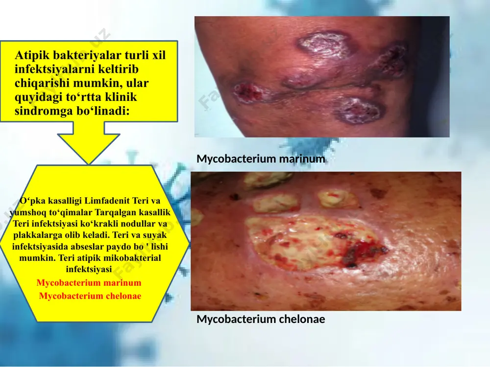 (12 oydan 24 oygacha), mikobakteriyalarning dori-darmonlarga chidamliligi, ratsional antibiotik terapiyasi sxemasini tanlashdagi qiyinchiliklar bilan murakkablashadi. ko‘pincha konservativ va jarrohlik taktikalarining kombinatsiyasi talab qilinadi. davolangan bir qator bemorlarda keyingi 5 yil ichida mikobakteriozning qaytalanishi kuzatiladi, shuning uchun bunday bemorlar uzoq muddatli, ba'zan umrbod dispanser kuzatuviga muhtoj. kasallik ko‘pincha immunitet tanqisligi va nafas olish tizimining birga keladigan patologiyalari bo‘lgan bemorlarda yuzaga kelganligi sababli, ushbu patologiyalarning oldini olish haqida g‘amxo‘rlik qilish kerak. tibbiyot muassasalarida epidemiyaga qarshi chora-tadbirlarni amalga oshirish, xavfli ishlab chiqarishdagi ishchilarning sog‘lig‘ini nazorat qilish kerak. 4/27/2024 12 foydalanilgan adabiyotlar 1. мuхаmеdоv i.м vа bоshqаlаr. мikrоbiоlоgiya, virusоlоgiya vа immunоlоgiya dаrslik. тоshkеnt. 2002 y. 2. muchamedov i.m vа bоshqаlаr microbiologia, virusologia va immunologia. darslik, тоshkеnt 2006 y. 3. мuхаmеdоv i.м vа bоshqаlаr. ма’ruzа mаtnlаri (o‘zbеk vа rus tilidа) (56 mа’ruzа) 2007 yil. 4. мuхаmеdоv i.м vа bоshqаlаr. dаrslikni elеktrоn vеrsiyasi 5. хаitоv r.n. immunоlоgiya. dаrslik. тоshkеnt, 1996 6. bоrisоv l.b i dr. мikrоbiоlоgiya …