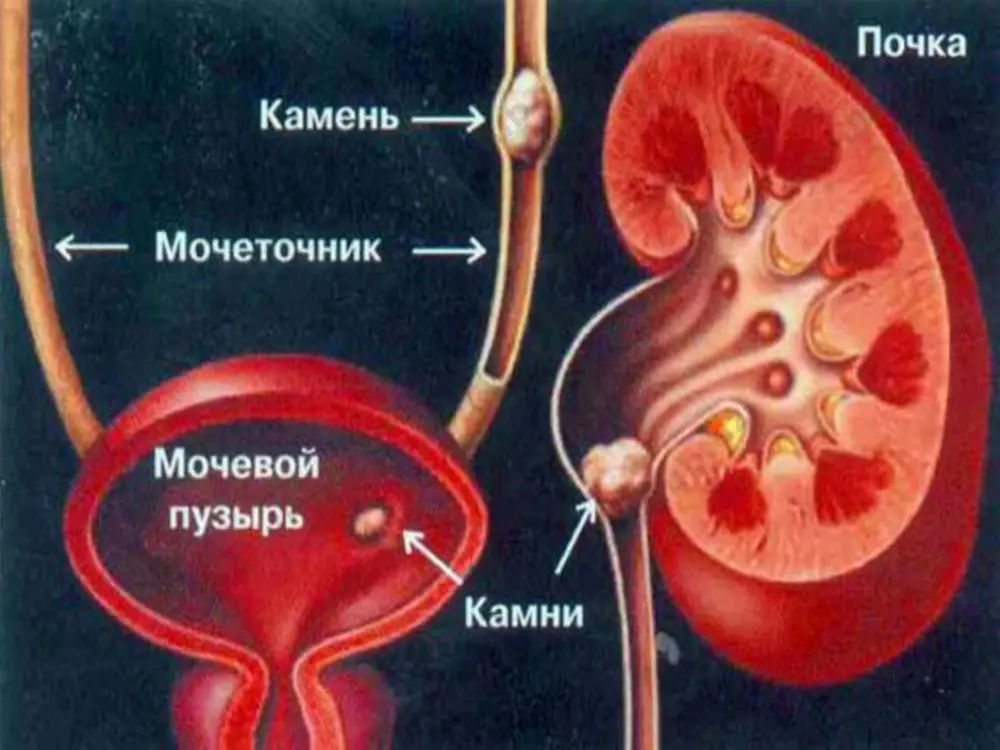 mehnat va boshq.) va maishiy hususiyatlar( bir xil, kamharakat hayot va dam olish tarzi). tosh hosil bo’lish protektorlari kontsentratsiyasiga, ph ga, diurezga va boshqalarga ta’sir qiluvchi tosh paydo qiluvchi moddalarni ko’p miqdorda saqlovchi oziq-ovqatlarni haddan tashqari va doimiy ravishda iste’mol qilish. a va b guruh vitaminlarining yetishmovchiligi. endogen etiologik havf omillari turlicha tabiatga ega bo’lishi mumkin. ularga mahalliy urologik havf omillari ham, umumiy havf omillari ham, shuningdek bemorning interkurrent kasalliklari kiradi. endogen etiologik omillar urologik omillar umumiy omillar urologik omillar siydik yo’llarining tug’ma va orttirilgan mahalliy o’zgarishlari(strikturalar, qo’shimcha qon tomirlar siydik oqimining buzilishi va gidronefrozga olib keladi) yagona (yagona ishlovchi) buyrak. qovuq-siydik nayi (buyrak) refluksi. siydik yo’llari anomaliyalari- g’ovaksimon, taqasimon buyrak, ureterotsele, shoxlangan kosachalar. siydik yo’llari infektsiyasi. umumiy omillar bir qator fermentlarning etishmasligi, yo’qligi, ortiqcha ishlab chiqarilish holatlari – giperparatireoz, podagra. uzoq yoki to’liq immobilizatsiya( umurtqa, chanoq suyaklarining sinishi va boshq.). oshqozon-ichak, jigar, o’t yo’llari kasalliklari. ichak rezektsiyalari, ingichka- yo’gon …