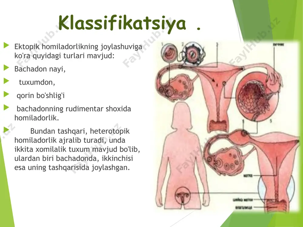 litopedion) bo'ladi. ektopik homiladorlik bilan ko'pincha naychani xomilalik tuxum bilan olib tashlash uchun operatsiya o'tkaziladi. naycha devorida homla rivojlanishi. naychali homiladorlik davrida tuxum biriktirilgan va hosil bo'lgan naychaning shilliq qavatida desidual reaktsiya rivojlanadi, bu shilliq qavatda ham, naycha devorida ham katta va engil desidual hujayralar paydo bo'lishi bilan tavsiflanadi. xomilaning villi membranasi shilliq qavatida ham paydo bo'ladi va horionik mushak qavatiga va uning tomirlariga kirib, naychaning to'qima elementlarini yo'q qiladi. shu munosabat bilan, tubal homiladorlikning birinchi oylarida naychaning bo'shlig'iga qon ketishi va homilaning naychaning bo'shlig'iga chiqishi mumkin - tugallanmagan tubal abort. o'lgan homila va uning qonga singib ketgan membranalari fimbrial uchi orqali qorin bo'shlig'iga chiqariladi - to'liq tubal abort. simptomlari. dastlabki bosqichlarda ektopik homiladorlik normal homiladorlikdan farq qilmaydi va ko'ngil aynish, uyquchanlik, ishtahaning oshishi, sut bezlarining kattalashishi va og'riq bilan birga bo'lishi mumkin. noxush alomatlar odatda oxirgi hayzdan 5-8 hafta o'tgach paydo bo'ladi. bularga quyidagilar kiradi: og'riq. bir tomondan qorinning …