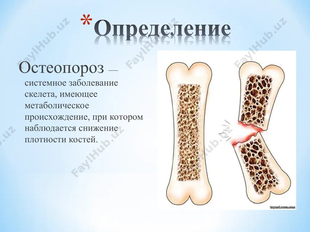 логий, которые могут приводить к разрушению костной ткани, при этом остеопороз чаще всего рассматривается в составе того или иного заболевания. * у остеопороза патогенез мало изучен, но известно, что развивается он на протяжении 10-15 лет до момента проявления видимых симптомов. считается, что это заболевание берет начало именно с факторов, способствующих его развитию. * костная ткань продолжает укрепляться и становиться более плотной вплоть до 35 лет, однако у людей, которые в будущем могут страдать от остеопороза, процесс укрепления костной ткани прекращается раньше. костная ткань имеет губчатую структуру. в нормальном состоянии губка костной ткани очень плотная, что придает упругость всей структуре. наблюдается медленное снижение плотности и упругости костной ткани, поэтому при этом заболевании клетки кости становятся очень рыхлыми. на протяжении долгого времени остеопороз может протекать скрытно. в костной ткани протекают сразу два процесса: изменение строения костных клеток и потеря кристаллов гидроксиапатита. критическая потеря солей кальция делает костную ткань очень ломкой, поэтому повышается …