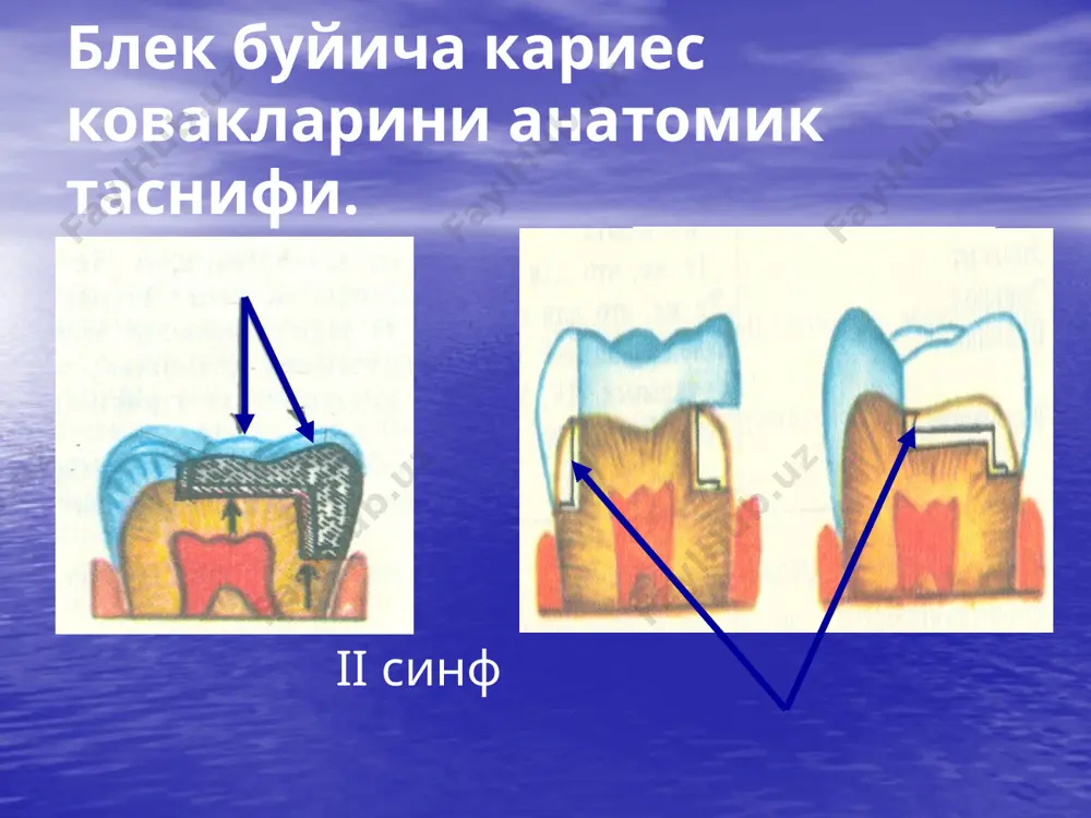 кариес ковакни чархлаш босқичлари ва услублари - Page 4
