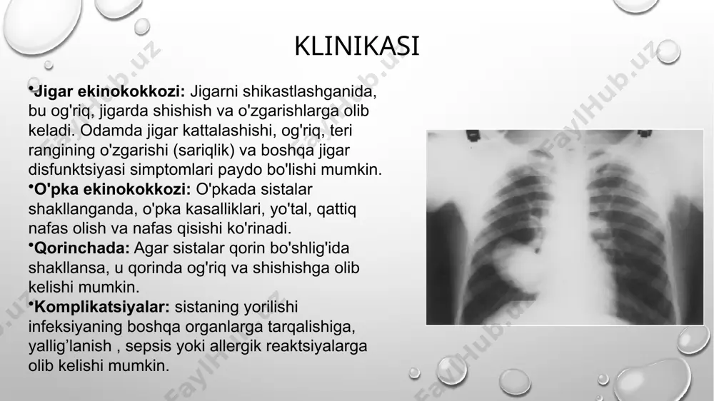 mida infektsiya davolanmasa, umumiy zaiflik, og'riqlar, qaltis nafas olish va bosh og'rig'lari paydo bo'lishi mumkin. davolash profilaktika dori-darmonlar: ankilostomozni davolash uchun antiparazitar dorilar ishlatiladi. albendazol va mebendazol — bu parazitlarga qarshi samarali dorilardir. piperazin va levamisol kabi boshqa dorilar ham samarali bo'lishi mumkin. qon donorlik: anemiya rivojlanishiga olib kelgan holatlarda, temir qo'shimchalari yoki qon transfuziyasi (qon quyish) talab qilinishi mumkin. gigiena: yuvilmagan oziq-ovqatni iste'mol qilmaslik, tualetdan keyin qo'llarni yuvish va ifloslanishga yo'l qo'ymaslik zarur. teri himoyasi: oyoqlarda maxsus kiyim yoki oyoq kiyimlardan foydalanish, yirtqich hayvonlar va boshqa zararlangan moddalar bilan to'g'ridan-to'g'ri aloqani kamaytirish. yerdan foydalanish: yerdan to'g'ri foydalanish, sog'lom tuproq va sanitariya sharoitlarini yaratish. hayvonlar va odamlar orasidagi aloqani nazorat qilish: uy hayvonlarini muntazam ravishda antiparazitar dori bilan davolash. gimenolepidoz gimenolepidoz (hymenolepiasis) — bu hymenolepis nana va hymenolepis diminuta nomli parazitlarning keltirib chiqaradigan gelmintoz kasallik. bu kasallik, odatda, ichakda parazitlarning rivojlanishi va tuxum qo‘yishi orqali amalga oshadi. u zoonoz bo‘lib, …