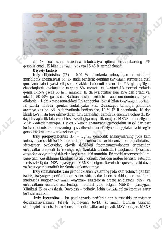 t shakllanishiga moyil bo‘ladilar. is ning ikki xil qo‘zg‘alishi ma’lum: gemolitik kriz va aplastik kriz. gemolitik krizning rivojlanishiga olib keluvchi omillar bo‘lib yuqumli kasalliklar, ayrim kimyoviy moddalar (masalan ortiqcha miqdorda ksenobiotiklar), psixogen stress xisoblanadi. gemolitik kriz belgilari: isitma, limon tusdagi sariqlik, teri va shilliq qavatlarining keskin oqarishi, bosh aylanish, bosh og‘rishi, ko‘ngil aynishi, qusish, ishtaxasizlik, qorindagi og‘riqlar (chap yarmida), paypaslaganda taloq kattalashishi va og‘rishi. gipoplastik krizni v19 parvovirusi chaqiradi va 10-14 kun oldin respirator infeksiya belgilari bo‘g‘imlarda uchuvchi og‘riqlar bilan boshlanadi. klinikasi anemiyaning keskin kuchayishi va gemik gipoksiya belgilari bilan namoyon bo‘ladi (bosh og‘rishi, bexollik, bo‘shashish, tez charchash, taxikardiya, taxipnoe va boshqalar). gemolitik krizdan farqli o‘laroq bu paytda retikulotsitoz bo‘lmaydi, aksincha retikulotsitlar soni kamayadi. aplastik kriz davomiyligi 2 xaftadan oshmaydi va ko‘pincha xech qanday davosiz tuzalib ketadi. ayrim xollarda eritrotsitar massaning quvvatlovchi transfuziyasi o‘tkaziladi. tashxislash. tashxis qo‘yishda genealogik anamnez yordam beradi, lekin xar doim emas, chunki kasallikni sporadik, shuningdek autosom–retsessiv …
