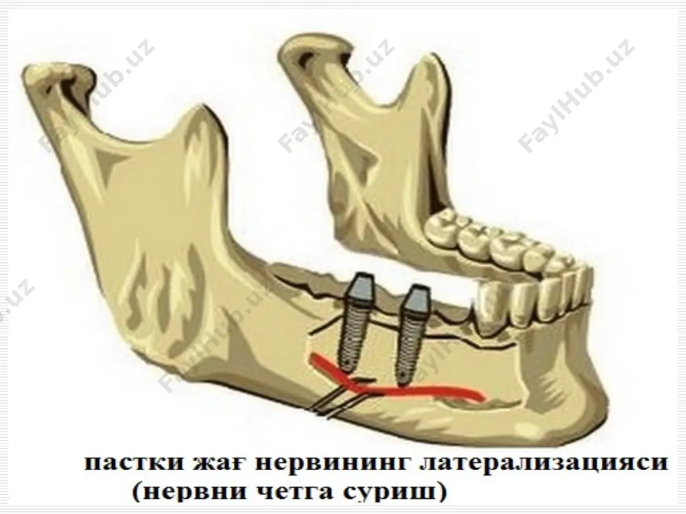 а уларни мукаммаллаштириш (синус лифтинг, пастки альвеоляр нервини латерелизацияси, альвеоляр ўсиғини ўстириш, вестибулопластика ва маҳаллий суяк деструкциясини бартараф этиш учун мемб-раналар ёрдамида йўналтирилган регенерацияни киритиш. бўлиши мумкин бўлган хатолик ва асоратлар эрта асоратлар: 1. яқин жойлашган анатомик хосилаларни: пастки жағ нерв-томир тутами шикастланиши, неврит, парез, невралгия, юқори жағ бўшлиғини перфорацияси 2. имплантатга жой шакллантиришда суякни куйиши; 3. қўшни тишларни жарохатланиши; 4. юмшоқ тўқималар жарохати; 5. инструментларни синиб қолиши кечки асоратлар: 1. имплантат остеоинтеграцияни нотўлиқлиги ёки йўқлиги ва имплантатни қимирлаб қолиши. 2. нерв толаси жарохатланганда турғун неврит, парез, невралгияни ривожланиши. 3. шиллик каватда сурункали эзилган яралар ёки оқма йўл пайдо булиши. 4. патологик милк чўнтагини шаклланиши ва периимплантит ривожланиши имплантацион чуқурча шакллантиришда инструмент синиб қолган холат пластинкали имплантат бўйин қисми синиб қолиши. тиш травмаси юқори жағ синуси имплант пенетрацияси таянч тиш ва суяк тўқимаси резорбцияси пластинкали имплантат соҳасида переимплантитнинг клиник белгилари конструкция ва таянч тиш олингандан кейинги холат имплантат олингандан сўнгги …