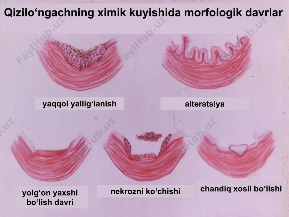 qizilo‘ngach kuyiuvchi moddalar - Page 5