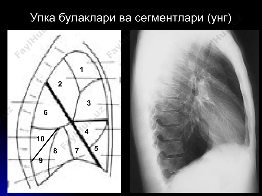 и кичраяди - ателектаз, цирроз. нормал - пневмония, сил. 3. соя гомогенлиги гомоген - ателектаз, плеврит. ногомоген - цирроз, диафрагмал чурра. шарсимон корайиш (1.5 см катта) касалликлар эхинококк туберкулома периферик рак гамартома аденома шарсимон пневмония метастазлар халталанган плеврит упкадан ташкари усма ва кисталар, аорта аневризмаси эхинококк улчами катта гомоген чегараси аник, текис куп сонли булиши мумкин асоратлашганда (халка-симон соя): «мениск» белгиси «парус» белгиси суюклик даражаси туберкулома купрок 2,6 сегментда жойлашади улчами 2-3 см сони - 2-3 булиши мумкин ногомоген – кальцинат + еругланиш чегараси аник нотекис «илдизга йул» симптоми учокли узгаришлар туберкулома периферик рак эркаклар 50-60 ешда купрок 3 сегмента сони купинча ягона улчами 4-6 см чегараси ноаник/ нотекис ногомоген (парчаланиш) «илдизга йул» + плеврит тез усади рак ичида кальцинат хеч качон булмайди !! периферик рак гамартома эркаклар 50-60 ешда купрок упканинг перифериясида улчами 2.5 см гача чегараси аник кальцинатлар секин усади аденома ёшларда купрок марказда (бронх ичида) усмани узи …