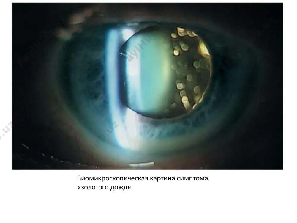 патология стекловидного тела - Page 3