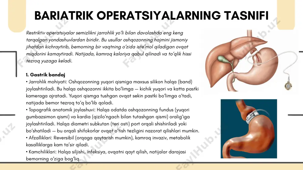 u bilio-pankreatik diversiya operatsiyaning maqsadi va mexanizmi: 1. oshqozonning distal qismi rezeksiya qilinib, hajmi kichraytiriladi (deyarli sleeve gastrektomiya kabi). 2. so‘ng, hazm qilish fermentlari oqimi bilan oziq moddalari oqimi alohida yo‘nalishda harakatlanadi, ya’ni duodenum butunlay chetlab o‘tiladi. oshqozon chiqishi bevosita distal jejunum yoki proksimal ileum bilan biriktiriladi (anastomoz qilinadi), hazm qiluvchi fermentlar esa keyinroq qo‘shiladi. shunday qilib, ovqat hazm fermentlari bilan yetarlicha aralashmagan holda distal ichaklarga tushadi va so‘rilmasdan organizmdan chiqariladi. topografik anatomiya: • oshqozonning korpus va fundus qismlari rezeksiya qilinadi. • pylorus saqlanadi, bu ovqatning fiziologik chiqarilishini tartiblaydi. • duodenum (o‘n ikki barmoqli ichak) to‘liq chetlab o‘tiladi. • anastomoz ko‘pincha jejunumning distal qismiga qo‘yiladi. • boshqa anastomoz orqali bilio-pankreatik yo‘l oxirgi qismga ulanadi — bu “common channel” deb nomlanadi va so‘rilish faqat shu qisqargan yo‘ldan amalga oshadi. afzalliklari: • juda yuqori vazn yo‘qotish natijalari. • metabolik sindromlar, diabet ii bosqichida samarali. kamchiliklari: • oziq moddalar, vitaminlar, minerallar yetishmovchiligi tez-tez …