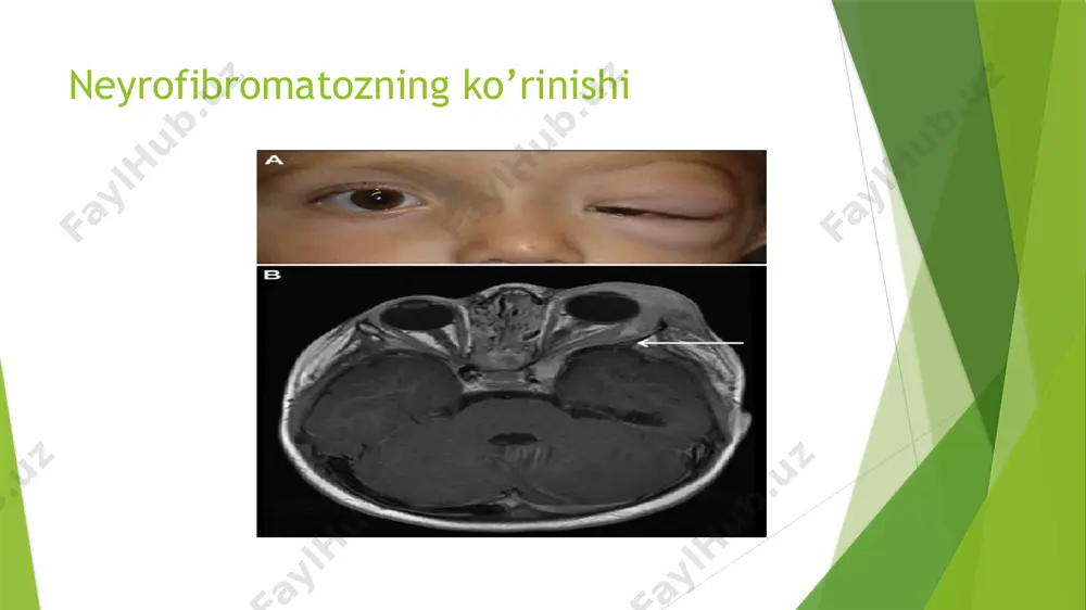 kin o‘sadi qo‘shimcha belgilar: teri ichiga botib turishi mumkin fibrosarkoma sababi: fibroz to‘qimalardan kelib chiqadigan saraton ko‘rinishi: qattiq, o‘suvchi tugun o‘sish xususiyati: tez o‘sadi, xavfli qo‘shimcha belgilar: yaralar, og‘riq dermatofibroma fibrosarkoma davolash pediatr, ortodont, jarroh-stomatolog ishtirokida kompleks dispanser nazorati oʻtkaziladi. oʻsma jarrohlik (bosqichma-bosqich operatsiya qilish) usuli yordamida olib tashlanadi. biroq, aksariyat hollarda oʻsmani toʻliq olib tashlash imkoniyati boʻlmaydi. dori-darmonlar neyrofibromalarni o‘sishini sekinlashtiruvchi dori vositalari. neyropatik og‘riqni kamaytiruvchi dorilar. davolash reabilitatsiya va qo‘shimcha yordam fizioterapiya – mushak va suyak muammolarini bartaraf etish uchun. nutq terapiyasi – agar bola nf2 sababli eshitish qobiliyatini yo‘qotsa. psixologik yordam – nf1 bilan bog‘liq o‘quv qiyinchiliklari va ijtimoiy muammolarni yengillashtirish uchun. e’tiboringiz uchun raxmat) image1.jpeg image2.jpeg image3.jpeg image4.jpeg image5.jpeg image6.jpeg image7.jpeg image8.jpeg image9.png image10.png image11.png image12.png image13.png /docprops/thumbnail.jpeg