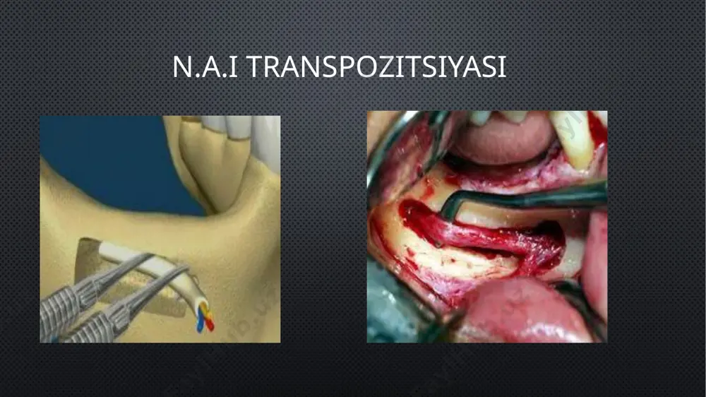 dental implantatsiyada pastki jag’da o’tkaziladigan qo’shimcha operatsiyalar - Page 5