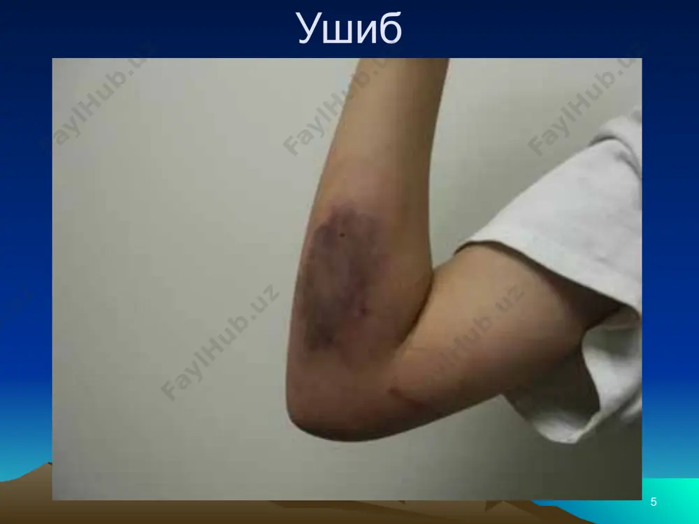 тандарт мвл утказишга шикастланганда  бугин сохасида куйиш ногиронликда чандик хисобига олиб белиши мумкин. критик куйиш критерийлари  30  10% утс  20  30% утс   20% - болалар  куйишда нафас йулларини шикастланади  кафтлар, оёгкафти, юзи ёки гениталийлар  куйиш тошка травма билан асоратланади  фонли касалликлар  электр ва кимёвий куйиш урта даражада куйиш критерийлари  30 2-10% утс  20 15-30% утс ( утс умумий жарохат хажми ужх)  10-20% - болалар  юзи, оёг кафти, гениталийдан ташкари  асоратсиз минимал даражали куйиш  30  2% утх  20  15% утх  10% - болалар 10  20% - утх термик куйишни бахолаш ва ёрдам курсатиш  имконият борича хавсиз жойга утказиш  енгинни тухтатиш  оловни учириш – куйган сохаларни совутиш  кийимни ва зартокинчокларни ечиш  кийимдаги предметлар терига ёпишган жойларда четитдан кесиб олиш лозим  упишган сакич, пластикни …