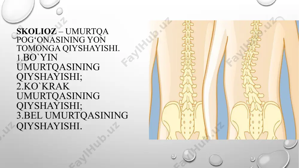 tik turgan holatda olingan rentgen suratlarni solishtirish indeks=180-α /180-α1 α-bemor yotgan holatda olingan roentgen suratidagi qiyshayish yoyining kattaligi α-bemor tik turgan holatdagi o’sha burchak barqarorlik darajasi 1dan( deformatsiya to’liq mustahkamlangan) 0 gacha (qiyshiqlikni mutloq harakatchan) o’zgarib turadi. odatda, indeksi 0,3 dan 1 gacha o’zgarishi mumkin. deformatsiya deformatsiya kuchayishi bemorning: yoshiga qiyshayish darajasiga turiga bog’liq. deformatsiyaning kuchayishi bolaning juda tez o’sish davriga to’ri keladi. eng cho’qqishi bola balog’atga yetish davrida -qizlarda 11-13 yosh o’g’il bolalarda 14- 16 yosh deformatsiya bola o’sishini to’xtashini yonbosh suyagi qanotining risser zonasida suyaklanish testiga ko’ra kuzatish mumkin, yonbosh suyagi bilan o’sish zonasining toliq birikib ketishi o’sishning to’xtaganligini bildiradi. elektromiografik tekshiruv mushaklarning xonsimetriyasi mushak sistemasi holatini aniqlash imkonini beradi. neyrogen skaliozlar uchun juda ahamyatga ega siydik va qon biokimyoviy ko’rsatkichlar katta ahamiyatga ega. chunki ular qandaydir darajada skalioz kelib chiqishining sabablarini , bazan esa skaliozda bo’ladigan chuqur o’zgarishlar (aminokislota va mukopolisaxatitlar almashinuvining buzilishi) va boshqalarni aniqlashga yordam …
