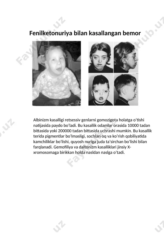 bunday ayollarning bo‘yi juda past bo‘ladi. ularda tuxumdon rivojlanmagan, ikkilamchi jinsiy belgilar juda sust namoyon bo‘ladi. shershevskiy-terner sindromi kasalligi o‘rta hisobda yangi tug‘ilgan 5000 ta qizdan bittasida uchraydi. shersheviskiy terner sindromi bilan tug’ilgan qizcha · tibbiy genetika uchun turli irsiy kasalliklar bo‘yicha geterozigota tashuvchilarni aniqlash katta ahamiyatga ega. chunki geterozigota tashuvchi organizm irsiy kasalliklar bilan o‘zlari og‘rimaydi. agar geterozigota tashuvchilar bir xil irsiy kasallikka ega bo‘lsa, bunday kishilar nikohidan tug‘ilgan bolalarning irsiy kasallik bilan tug‘ilish ehtimoli ko‘pdir. · buning oldini olish uchun maxsus tibbiy-genetik maslahat markazlari tashkil etilib, oila qurishga qaror qilgan yoshlarga, ular oilasida tug‘iladigan farzandlar salomatligi haqida tushuntirish ishlari olib borilmoqda. odam irsiyatiga, belgi va xususiyatlarning rivojlanishiga spirtli ichimliklar, ko‘knor, qoradori, nasha kabi narkotik moddalar juda yomon ta’sir qiladi. ichkilikboz, nashavand, narkomanlar oilasida tug‘ilgan bolalarning aksariyatida aqliy va jismoniy jihatdan zaiflik uchraydi. demakki, sog‘lom avlod uchun kurash, irsiy kasalliklarning oldini olish va davolashning yangi usullarini ishlab chiqish tibbiyot …