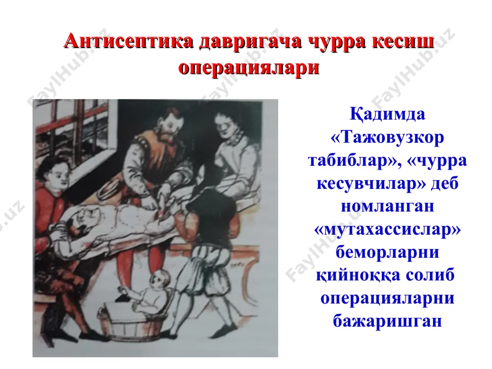 чурра қопи уруғ тизимчасидан ташқарида жойлашган чурра қопи уруғ тизимчасидан ичкарида жойлашган чов чурраларида бажариладиган кесма чов каналини олдинги девори пластикаси жирар усули чов каналини олдинги девори пластикаси спасокукоцкий усули чов каналини олдинги девори пластикаси жирар-спасокукоцкий усули кимбаровский чоклари билан чов каналини орқа девори пластикаси бассини усули туғма чов чуррада жаррохлик амалиет бажариш усули сон учбурчагининг топографияси сон чуррасининг кўриниши сон чуррасида операциялар усуллари чов канали томонидан бажариладиган операциялар руджи усули руджи-парлавечио усулли райх усулли праксин усули сон томонидан бажариладиган операциялар локвуд усули локвуд-бассини усулли локвуд-крымов усули абражанов усули сон чуррасида кесмалар руджи усули райх усули праксин усули локвуд усули локвуд-бассини усули абражанов усули киндик чуррасини хирургик анатомияси 1 — тери; 2 — тер-ости-ег кавати; 3 — чурра аъзоси; 4 — m. rectus abdominis; 5 — fascia transversalis; 6 — peritoneum; 7 — чурра халтаси киндик чуррасида қўлланиладиган кесмалар 1- сапежко усули 2- мейо усули 3- лексер усули лексер усулида …