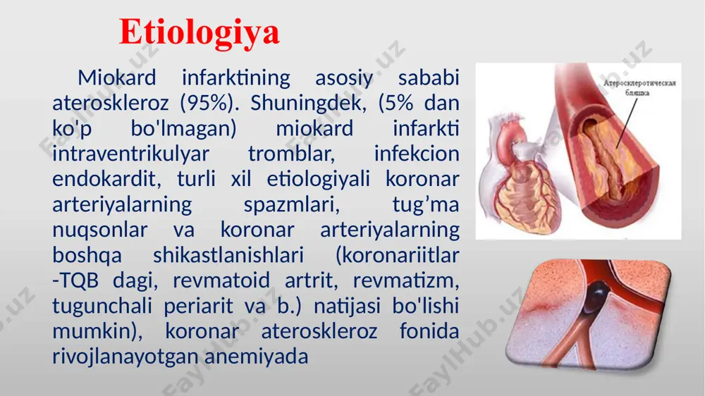 riyada aniqlanadi. ushbu hodisa rezorbsion-nekrotik sindrom deb ataladi. miyokard infarktining laborator diagnostikasi(davomi) leykotsitoz-neytrofilez - nekrotik o'zgarishlarga javoban yallig'lanishning namoyishi sifatida; (odatda 12-15 x 109 / l., aneosinofiliya,) - bir necha soatdan so'ng, 2-4 kundan keyin eng yuqori darajaga, bir haftadan so'ng - normallashadi echt mi boshlangandan 12 soat o'tgach ko'tariladi - (1-2 hafta) - yallig'lanish rivojlanishi tufayli yuzaga keladigan oqsil fraktsiyalari orasidagi miqdoriy nisbatdagi o'zgarishlarning aksi sifatida ast alt (sitolizning o'ziga xos bo'lmagan markerlari) midan 8-12 soat o'tgach ko'tarila boshlaydi. u eng yuqori darajasiga 24-48 soat ichida erishadi va 3-7 kunlari normallashadi. mi instrumental diagnostikasi 1. ekg (ma’lumoti -xabardorlik - 85%) 2. echo kg (diskineziya, anevrizmalar, miokardning yorilishi va boshqalar) 3. ko'krak qafasi rentgenogrammasi 4. anjiyografiya (miokard qon ta'minoti tiklanish darajasini baholash uchun) 5. sutkalik monitorlash (aritmiyalar, o‘tkazuvchanlikning buzilishi im darak beradi) 6. miokardni perfuzion sintigrafiyasi (ts99m-texnitril bilan). miokardni perfuziyasini pasayishini ko’rsatadi. 7. 201t1 bilan skanirlash. imdan keyin bir necha …