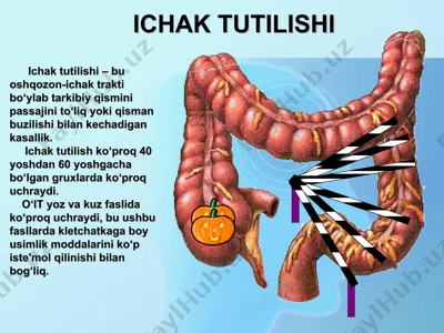 ichak tutilishi — PPT