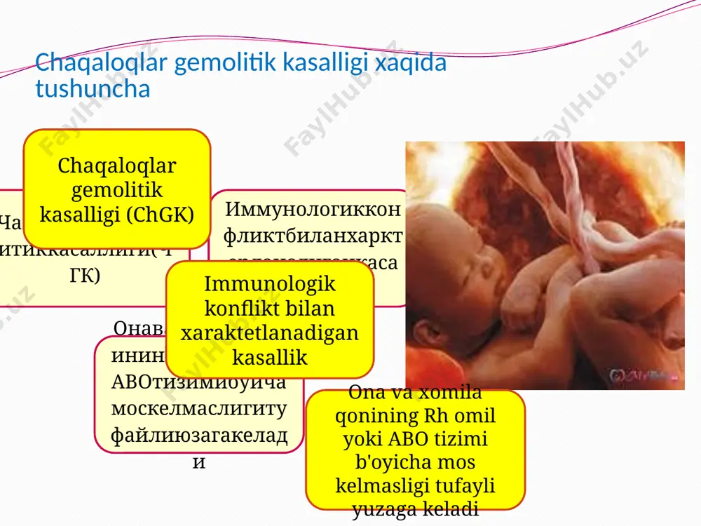 ha sensilizatsiya sabablari intranatal davrda kesarcha kesish, yo'ldoshni qo'l bilan ko'chirish va x.k. oldingi xomiladorliklar, abortlar, xomila tashlashlar ayolga rh(+) qon qu'yilishi резусмоскелмасликбуичасенсибилизациясабаблари аёлгаrh(+)конкуйилиши интранаталдаврдакесарчакесиш,йулдршникулбиланкучиришвах.к. олдингихомиладорликлар,абортлар,хомилаташлашлар; klassifikatsiya 1. mos kelmaslik turiga ko’ra: -rh omil bo’yicha mos kelmaslik -abo tizimi bo'yicha mos kelmaslik 2. kliinik shakliga ko’ra: -shish (2%) -sariqlik (87%) -anemik (1%) -xomila ichi nobud bo'lishi 3.ogirlik darajasiga ko'ra: -og’ir -o'rta og’ir -yengil klinikа shish shakli oaa - bola tashlash, o'lik tugilish, oldingi xomiladorlikda chala tugilish, chgk, og'ir gestozlar, preeklampsiya xomila ichi nobud bo'ladi, yoki chala tugiladi prenatal davrda yo'ldosh kattalashuvi, “budda” pozasi klinikasida: teri oqarishi, yuzi, qo'l-oyoqlar, jinsiy a'zolar, qorin oldi devorining shishi,og'ir darajada anasarka, sdr, gemorragik sindrom, yurak-nafas yetishmovchiligi, jigar va taloq keskin kattalashgan laborator taxlilda-gipoproteinemiya, anemiya, trombotsitopeniya, eritrotsitlar keskin kamaygan, eritroblastoz; bilirubin 300-400 mkmol/l dan baland shish shakli shish shakli shish shakli баланд. sariqlik shakli sariqlikni erta namoyon bo'lishi; 3-4 kun ichida intensivligi ortishi; sariqlik bosqichma boskich …