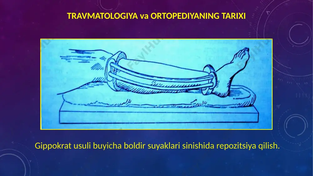 rdam ko'rsatishda yara atrofidagi terini antiseptik eritma bilan tozalash va steril bog’lam qo'yish kerak. qon ketishni to'xtatish uchun gemostatik turniketni qo'llash kerak bo'lishi mumkin. birinchi yordam ko'rsatayotganda, oyoq-qo'lning mavjud deformatsiyalarini to'liq tuzatishga harakat qilmaslik kerak, asab va qon tomirlariga zarar bermaslik kerak. birinchi yordam va transport immobilizatsiyasi diterixs shinasi operativ usullar intramedullyar ekstramedullyar tashqi fiksatirlar intramedullyar osteosintez ekstramedullyar osteosintez tashqi fiksatorlar fiziologik va reparativ regeneratsiya farqlanadi fiziologik regeneratsiya - organizm normal xayot tarzidagi regeneratsiya boʼlib, odatda jaroxatlar yoki organ qismi yoʼqotilishi bilan bogʼliq emas. reparativ regeneratsiya - jaroxatlar yoki qaysidir organ yoki organizmning qismini yoʼqotilishida yuzaga keladigan regeneratsiya. suyak to’qimasining regeneratsiyasi va singan suyaklarning bitishi suyak bitishi morfologik jihatdan 5 davrga bo’linadi. suyak bitishi klinik jihatdan 4 davrga bo’linadi. (a.v. kaplan 1967) morfologik davrlar birinchi davr – jarohat atrofida shish suyuqligi va gematoma yeg’ilishi natijasida fibrindan mezenximal jelesimon modda rivojlanadi - “birlamchi yelim”. 10 kun. buek: g-e. birlamchi kadok markazidagi …