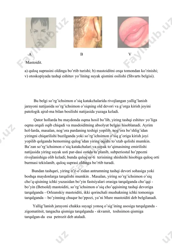 ashqi eshituv yo’lining suyak qismini osilishi (shvarts belgisi). bu belgi so’rg’ichsimon o’siq katakchalarida rivojlangan yallig’lanish jarayoni natijasida so’rg’ichsimon o’siqning old devori va g’orga kirish joyini patologik ajral-ma bilan bosilishi natijasida yuzaga keladi. qator hollarda bu maydonda oqma hosil bo’lib, yiring tashqi eshituv yo’liga oqma orqali oqib chiqadi va masdoiditning absolyut belgisi hisoblanadi. ayrim hol-larda, masalan, nog’ora pardaning teshigi yopilib, nog’ora bo’shlig’idan yiringni chiqarilishi buzilganda yoki so’rg’ichsimon o’siq g’origa kirish joyi yopilib qolganda bemorning qulog’idan yiring oqishi to’xtab qolishi mumkin. ba’zan so’rg’ichsimon o’siq katakchalari va suyak to’qimasining emirilishi natijasida yiring suyak usti par-dasi ostida to’planib, subperiostal ho’ppozni rivojlanishiga olib keladi; bunda quloq or-ti terisining shishishi hisobiga quloq orti burmasi tekislanib, quloq suprasi oldinga bo’rtib turadi. bundan tashqari, yiring o’z-o’zidan antrumning tashqi devori sohasiga yoki boshqa maydonlarga tarqalishi mumkin . masalan, yiring so’rg’ichsimon o’siq cho’q-qisining ichki yuzasidan bo’yin fastsiyalari orasiga tarqalganda cho’qqi - bo’yin (betsold) mastoiditi, so’rg’ichsimon o’siq cho’qqisining tashqi devoriga tarqalganda …