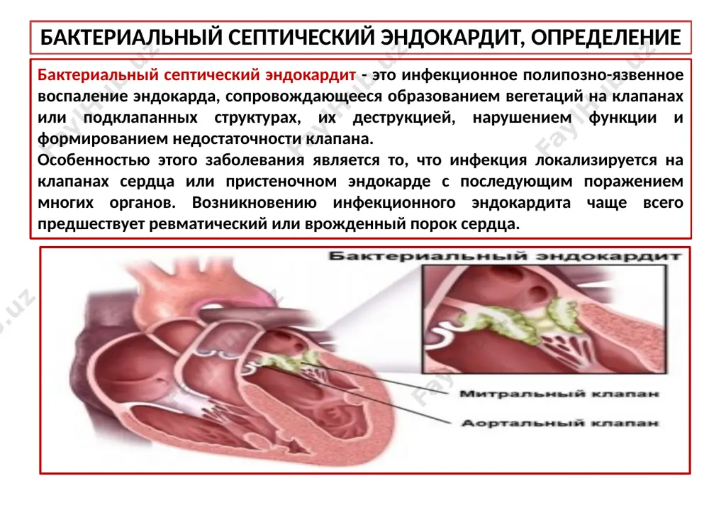 елка. дистрофическая фаза - развивается только у тех больных, кто пережил сепсис и повреждение органов в иммунно - воспалительную фазу. смерть больных наступает в результате повреждения внутренних органов. клиническая классификация течение: острый, длительностью менее 2 месяцев, подострый, длительностью более 2 месяцев. хроническое рецидивирующее течение стадия: инфекционно-токсическая иммунно - воспалительная дистрофическая степень активности: высокая (iii) умеренная (ii) минимальная (i) клинико-морфологическая: первичный иэ (на интактных клапанах) вторичный иэ (при клапанных и сосудистых повреждениях) особые формы: больничный иэ: протезированных клапанов, у лиц с электрокардиостимулятором (экс), иэ у лиц с трансплантированными органами, иэ у лиц, находящихся на гемодиализе, иэ наркоманов, иэ у лиц пожилого и старческого возраста (марантический). исходы: выздоровление ремиссия неэффективность рецидив клиника бактериального септического эндокардита лихорадка гектического типа с повышением температуры до 40*с, ознобы и потливость; реже - волнообразная лихорадка, субфебрилитет. выраженная астенизация - слабость, быстрая утомляемость, головные боли, снижение аппетита, миалгия, полиартралгия, похудание. кардиалгический синдром- одышка при небольшой физической нагрузке или …