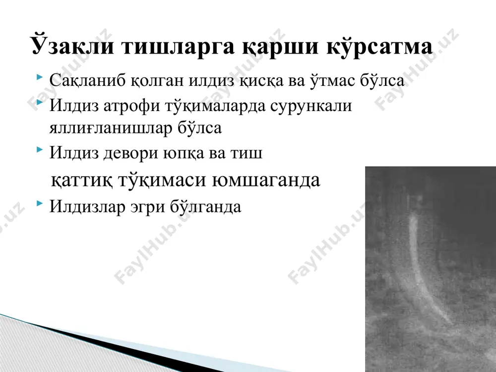 и. (шуни айтиб ўтиш керакки, ўзакка шакл бераётган пайтда унинг ҳар битта сегмент илдизлари тиш каналига мос бўлиб, бир-бирлари билан тиш илдизлари бифуркацияси устига туғри келадиган чизиқдан сегментларнинг тож қисмларига шакл берилади. бу чизиқ қиялик бурчаги тиш каналларининг биттасининг канал қиялик бурчагига тенг бўлиши керак.ўзакли тишнинг тож кисми ўзаро бирлашиб кетган бўлса, уларни юпка сепарацион диск билан қўлда бир-биридан эҳтиёткорлик билан ажратилади метал қотишмаларидан қуйилади. кейинчалик бемор тиш илдизига тайёрланган қуйма ўзак ўлчаб кўрилади. сўнг тайёрланган конструкциялар пардозланиб тиш илдизларига кетма-кет цементлаб ўрнатилади. тайёрлашнинг 2 хил усулини таклиф қилишган. 2- усул пластмасса қаламчалар танлаб олинади ва унга мослаштирилади. ўлчанган ўзакларни ўз-ўзидан қотадиган пластмасса (редонт, протакрил) билан қопланади ва тиш илдизларига кийдирилади. бир оз ўтгач ўзаклар чиқарилиб пластмасса тўлиқ полимеризация бўлгандан кейин яна ўзаклар тиш илдизларига кийдирилиб, жағлардан ишчи ва ёрдамчи қолиплар олинади. тиш каналлари вақтинча пломба ёки тампон билан беркитилади. ўзакли тишларни тайёрлашнинг бир қатновли усули : 2 биринчи усули …