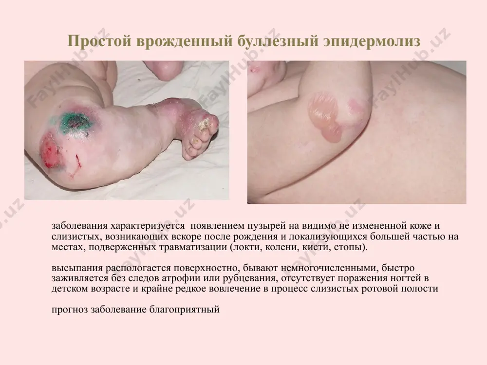 но с рождения или вскоре после него в раннем возрасте процесс носит генерализованный характер, в дальнейшем пузыри локализуется на разгибательной поверхности конечностей и тыле кистей после заживления пузырей на пораженных участках образуются рубцы, обычное келоидные, появляются псевдомилиумы у большенство больных ногти дистрофичны или полностью нарушаны поражение слизистых оболочек встречается в 20% случаев течение заболеваниея более легкое по сравнению с рецессивным типом дистрофического буллезного эпидермолиза прогноз для жизни благоприятный эта форма заболевания начинается как при полидиспластической форме однако пузыри не заживают годами, а на их месте образуются вегетирующие язвы, хотя с возрастом количество появление новых пузырей значительно уменьшается поражение слизистых оболочек и ногтей протекает тяжело язвенно-венетирующая форма заболевания прогноз заболевания прогноз зависит от формы заболевания: - при простых формах - благоприятный, - при пограничном бэ тип герлица - неблагоприятный - рециссивный дистрофический бэ имеет - тяжелое осложнения и значительно ухудшает качество жизни больных - возможно развитие карциномы, которая быстро прогрессирует и …